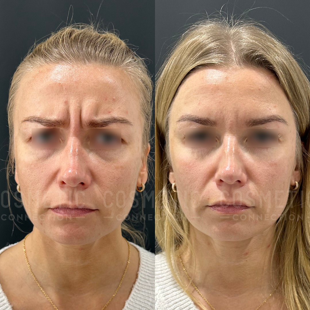 Two side-by-side photos of the same woman with a neutral expression. The left shows her furrowing her eyebrows, while the right shows a relaxed smooth forehead. She has light skin and straight, light brown hair.