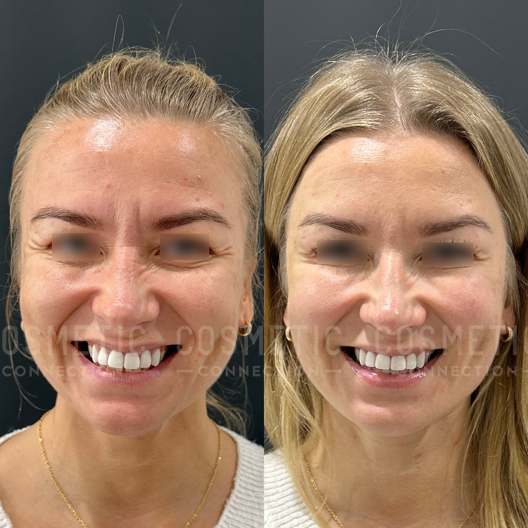 Side-by-side comparison image showing a womans face before and after a cosmetic procedure. The left side shows her with minor forehead lines and blemishes, while the right side shows smoother skin with a more even complexion. Both images have blurred eyes.