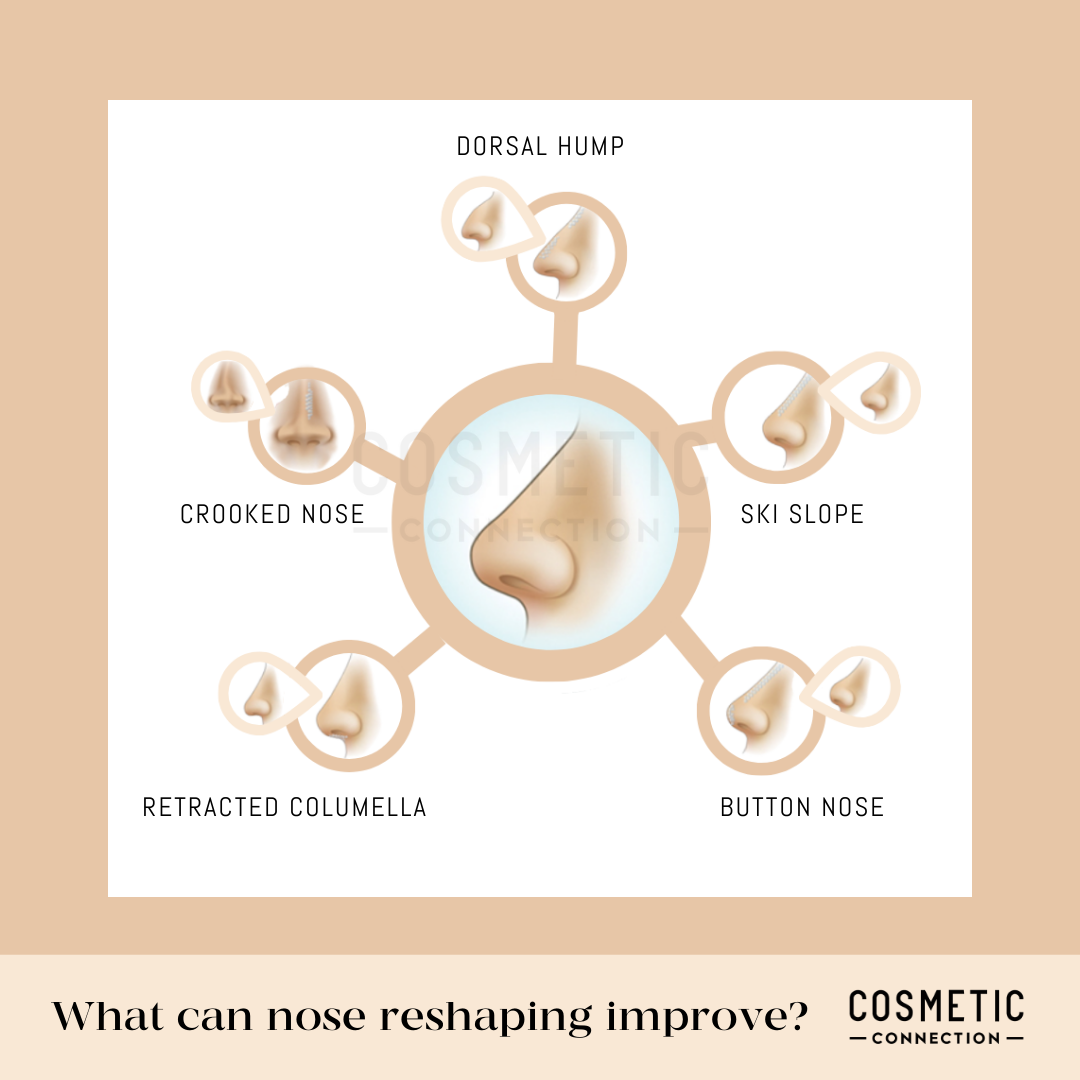 An infographic illustrating different types of noses that can be reshaped: dorsal hump, crooked nose, ski slope, retracted columella, and button nose. Each type is connected to a central image of a stylized nose.