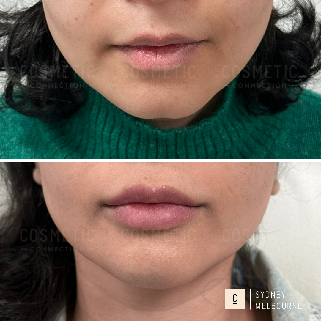 Close-up photos of a persons lips and chin, showing a comparison before and after a cosmetic procedure. The top image displays natural lips, while the bottom shows fuller lips. Both images have a watermarked background with location text.