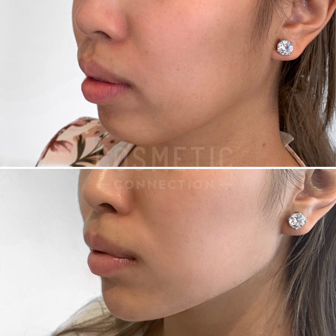 Close-up side-by-side images showing a womans lower face before and after a cosmetic procedure. In both images, she wears a floral patterned top and round diamond earrings. The second image shows a slightly more defined jawline.
