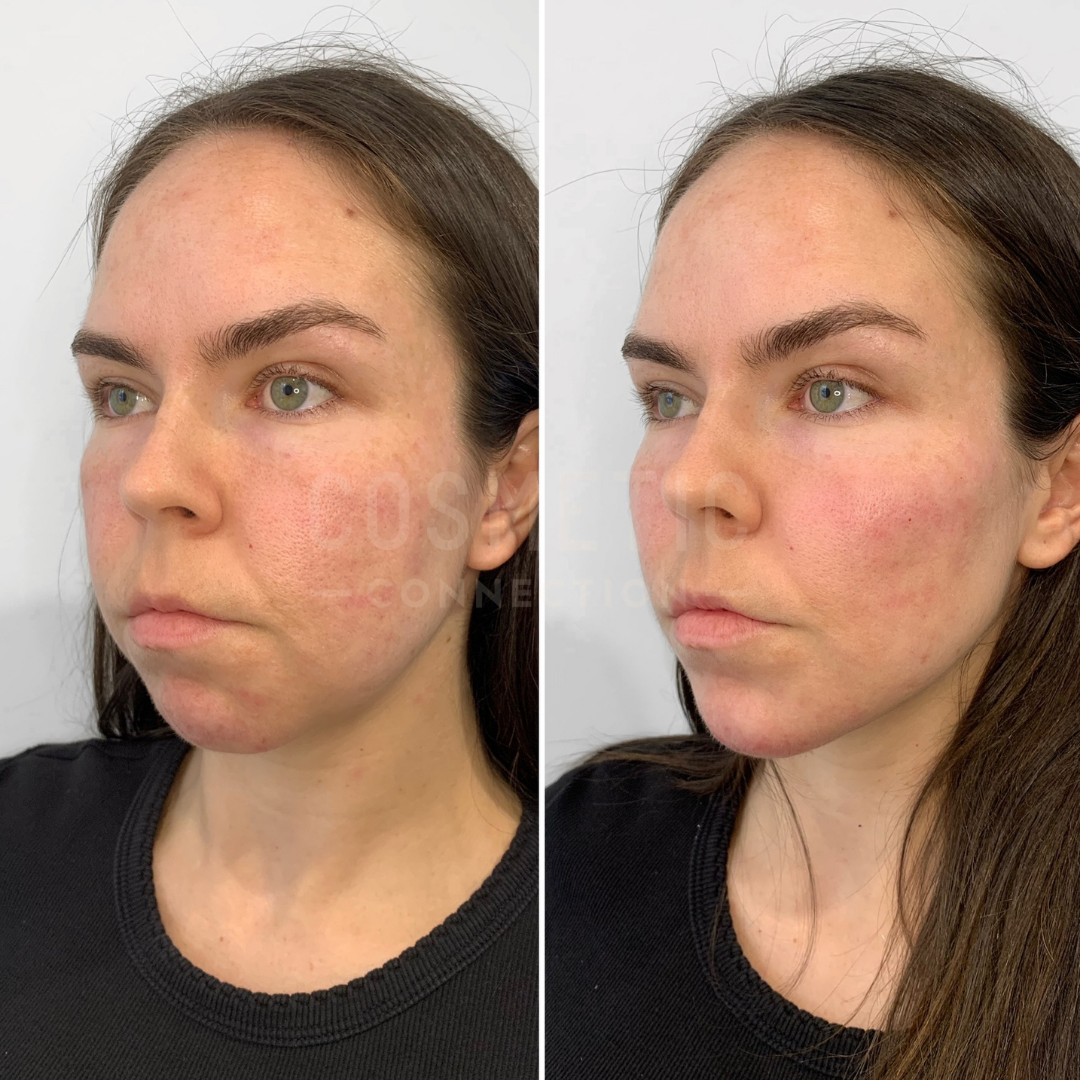 Side-by-side images of a woman with long dark hair, showing a close-up of her face with visible redness and slight irritation on her cheeks. She wears a black shirt and looks straight in the first image and slightly to the side in the second.
