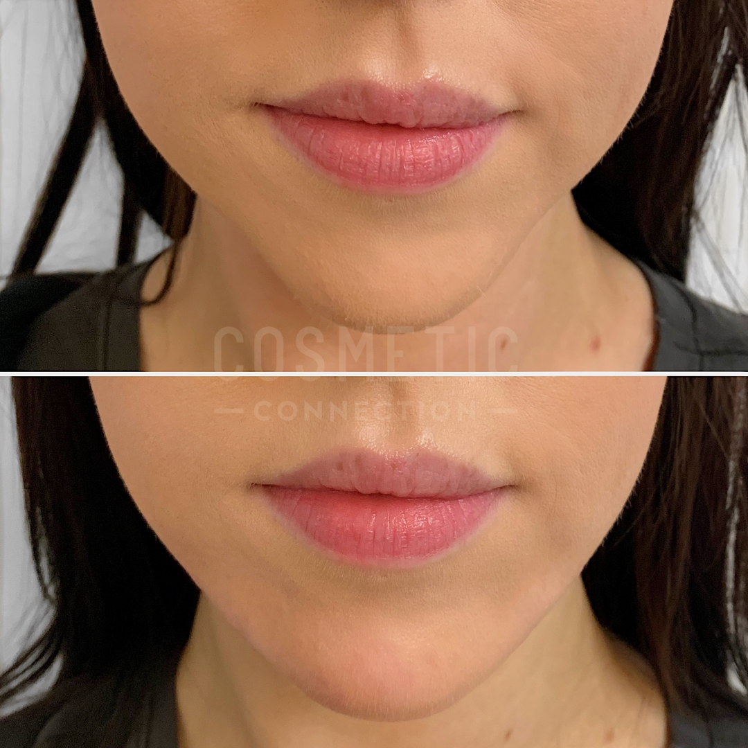 Close-up of a persons lips shown in two images for a before-and-after comparison. The top image shows natural lips, while the bottom image reveals plumper lips after a cosmetic procedure. The background is neutral, focusing on the lips.