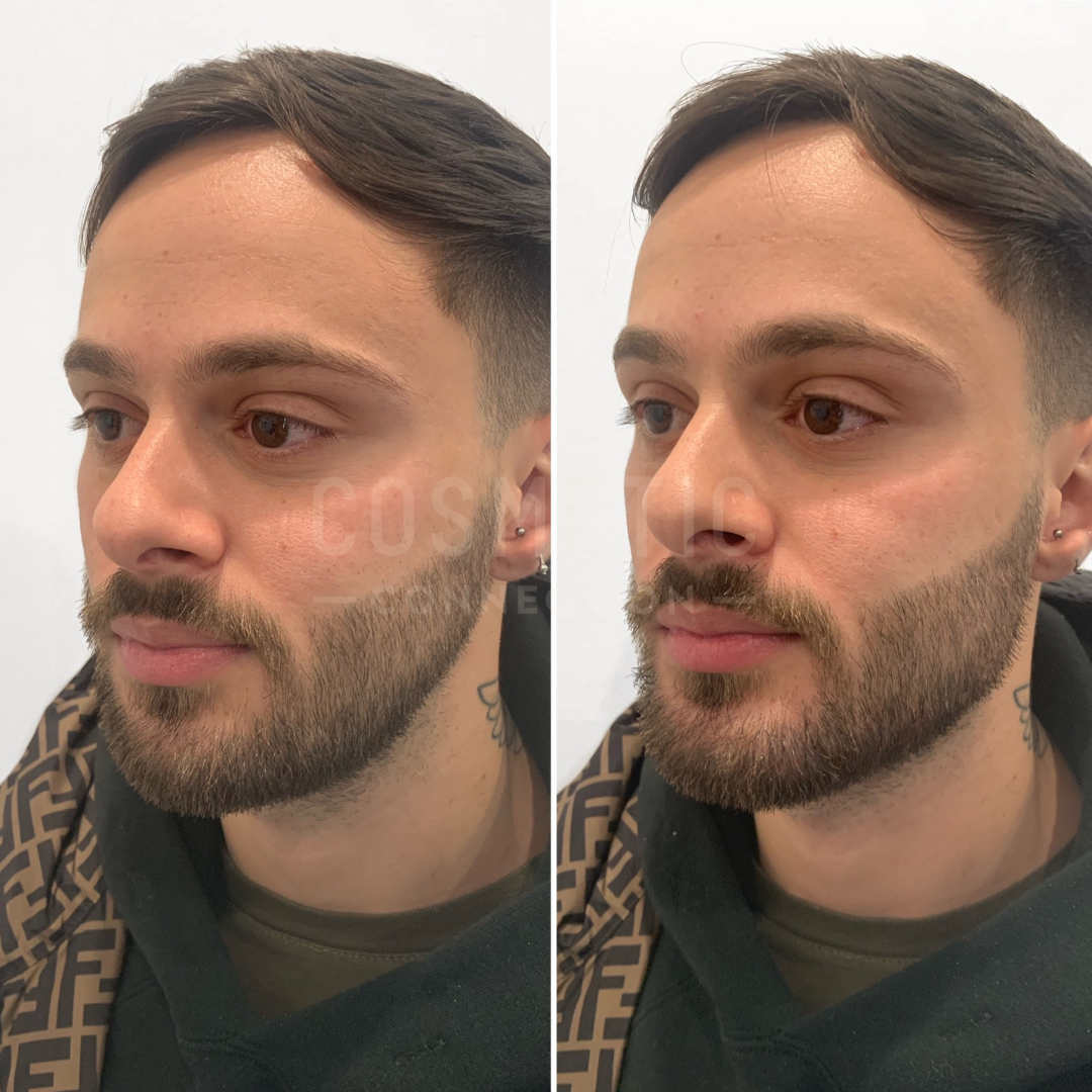 Side-by-side images showing a young man with a parted hairstyle and beard gazing to his left. The background is a plain white wall, and he is wearing a patterned jacket over a green hoodie.