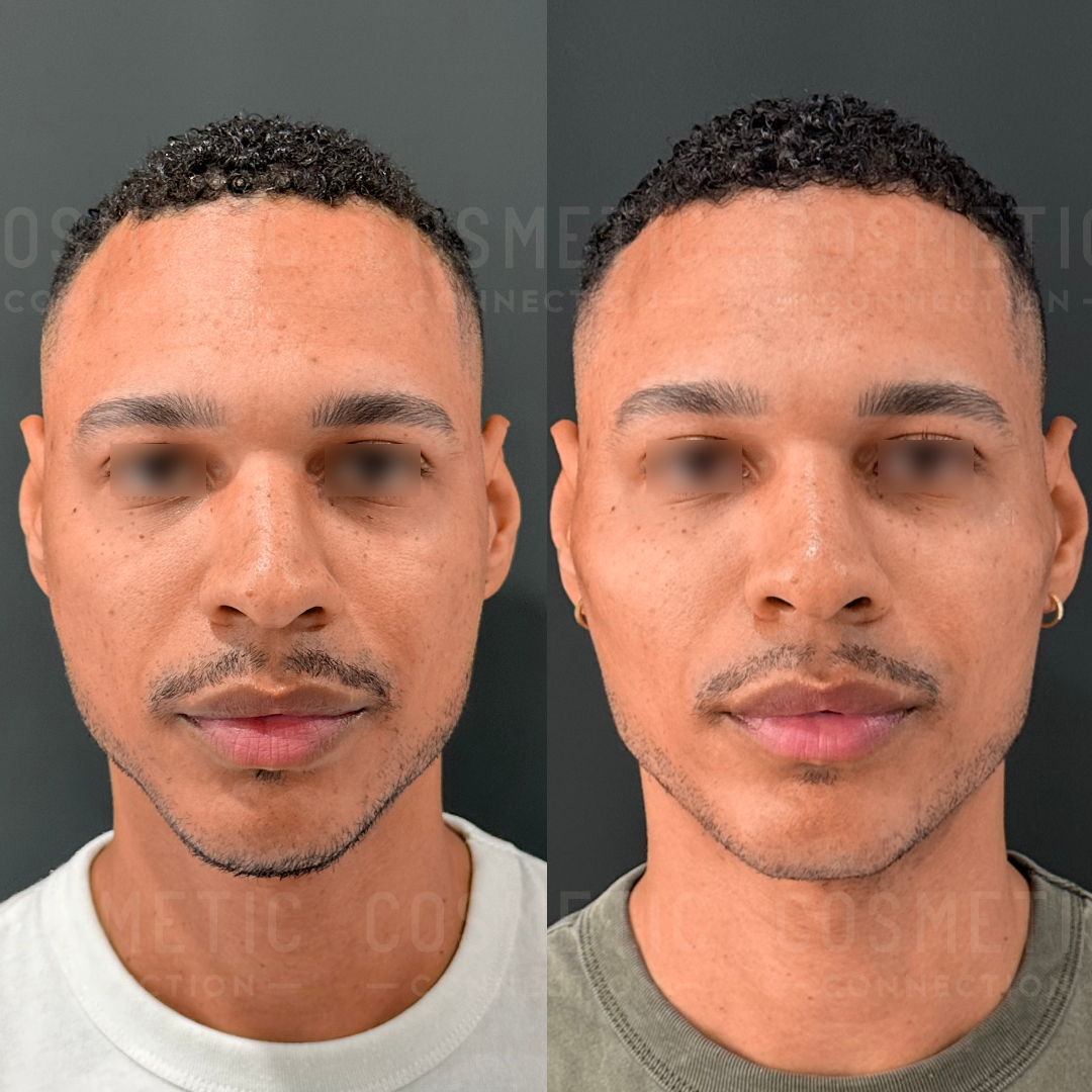 Side-by-side images of a man before and after a cosmetic procedure. The man has short curly hair and a trimmed beard. In the after image, his jawline appears more defined. Both images have blurred eye areas for privacy.