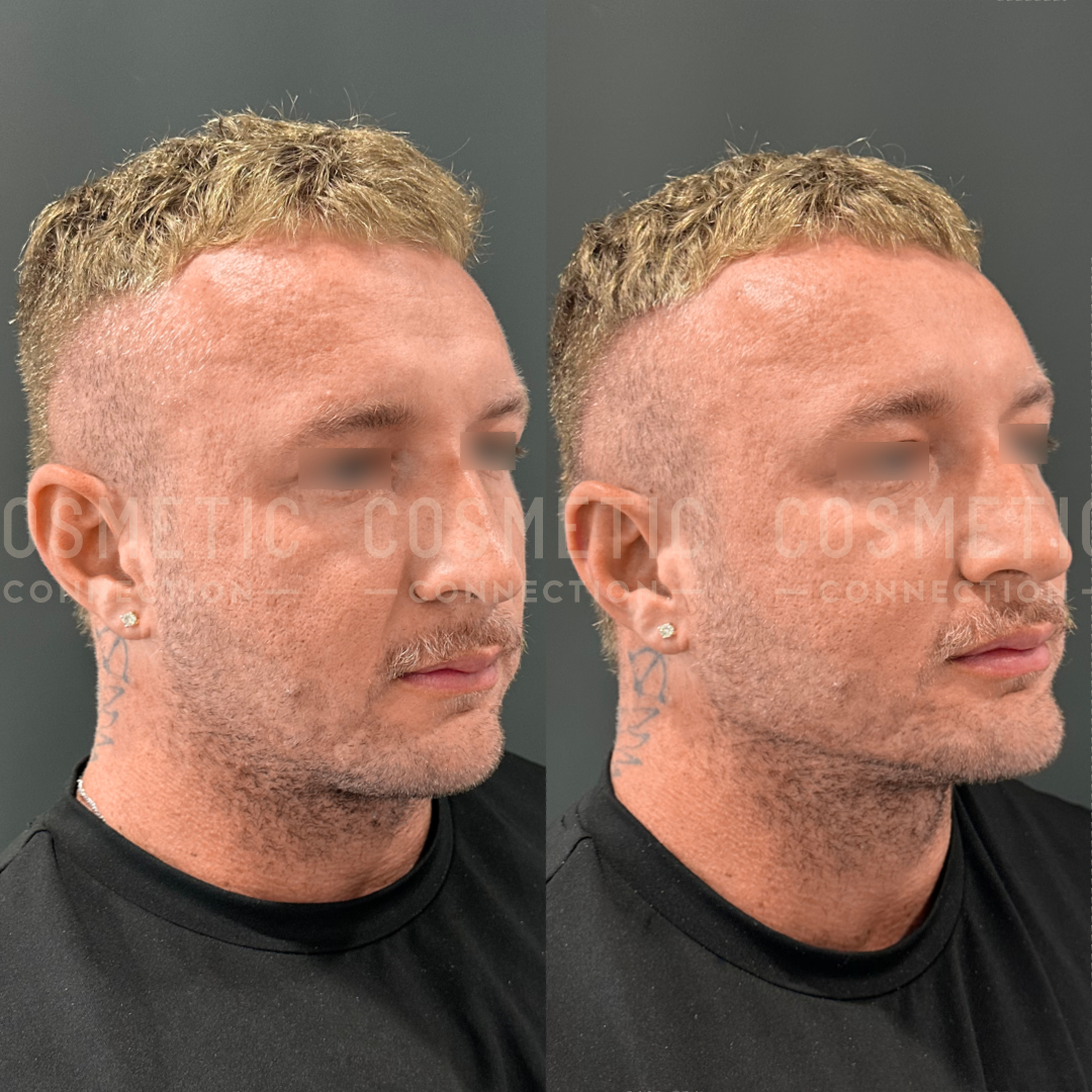 Side-by-side comparison of a mans head, showing a hair transformation. The left image has thinner hair, while the right shows thicker, fuller hair. The man has a tattoo near his left ear and is wearing black.