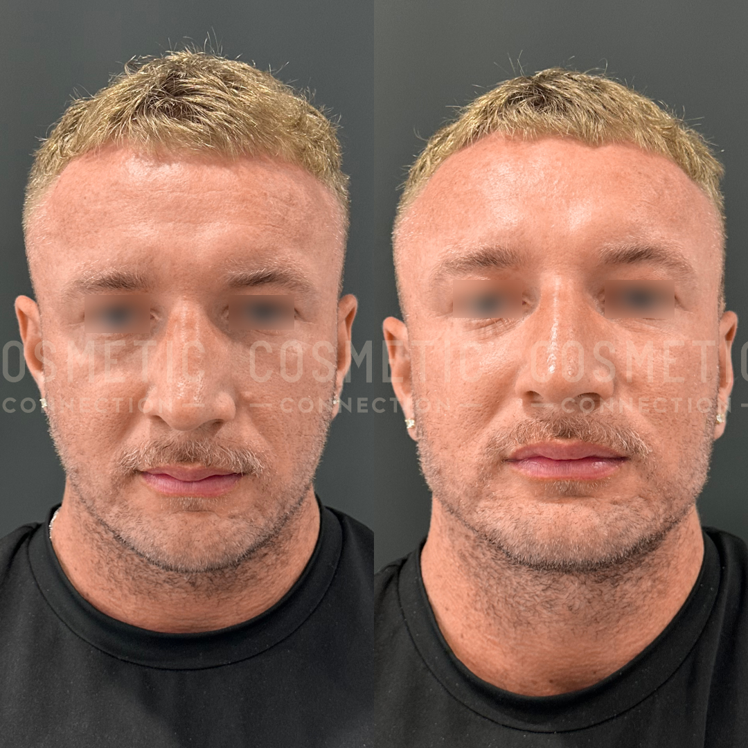Side-by-side comparison image of the same individual before and after a cosmetic procedure. The person has short, light blonde hair and is wearing a black shirt. The background is plain and dark, emphasizing the facial changes.