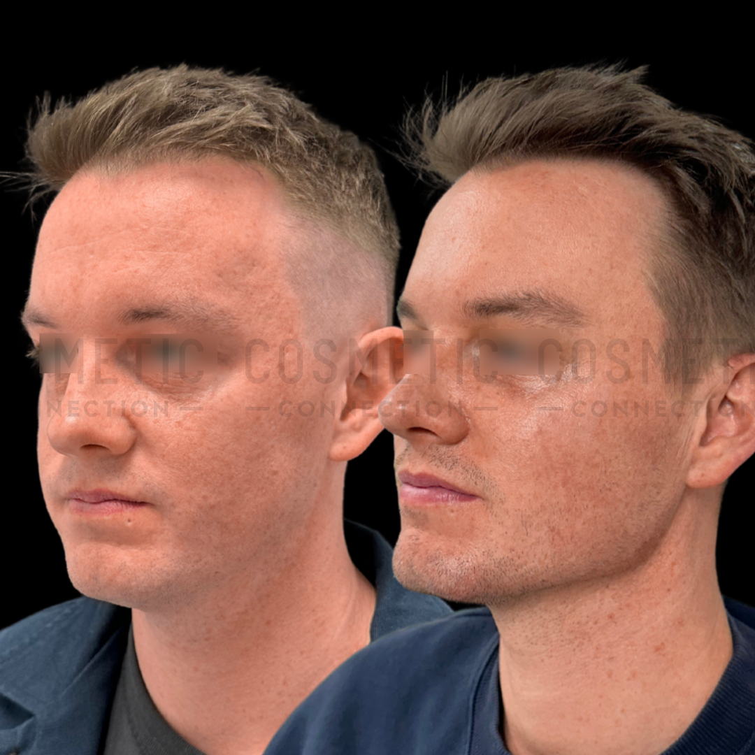 Side-by-side before and after images of a man facing slightly to the right. The before image shows visible skin texture, while the after image displays smoother skin. Both images have a watermark across the face.