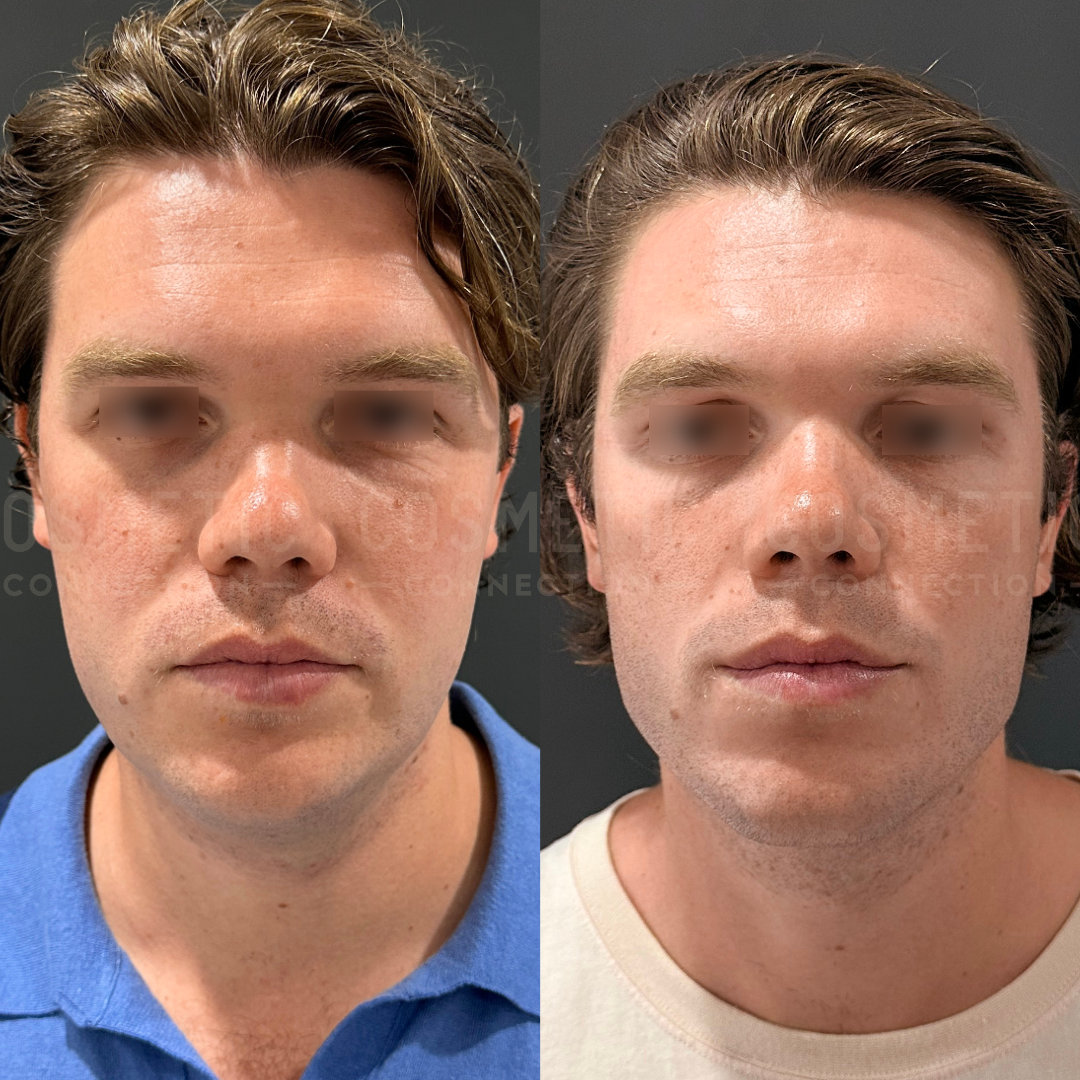 Side-by-side before and after images of a person with styled short brown hair, wearing a blue shirt on the left and a beige shirt on the right, showing subtle differences in facial features and skin tone.