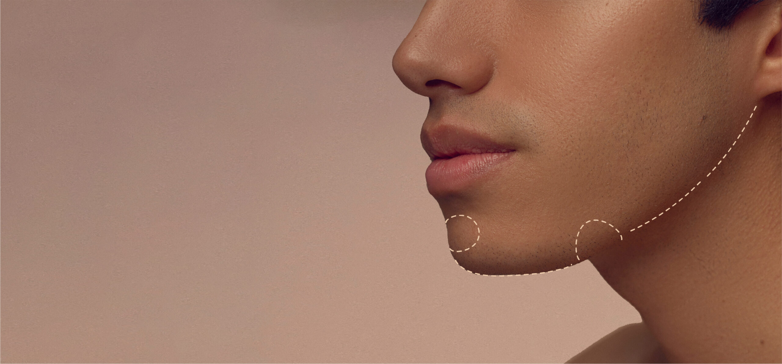 A close-up side profile of a person’s face, focusing on the jawline and chin. Dotted lines are drawn around the chin area, possibly indicating cosmetic enhancement or contouring. The background is a soft, blurred beige.