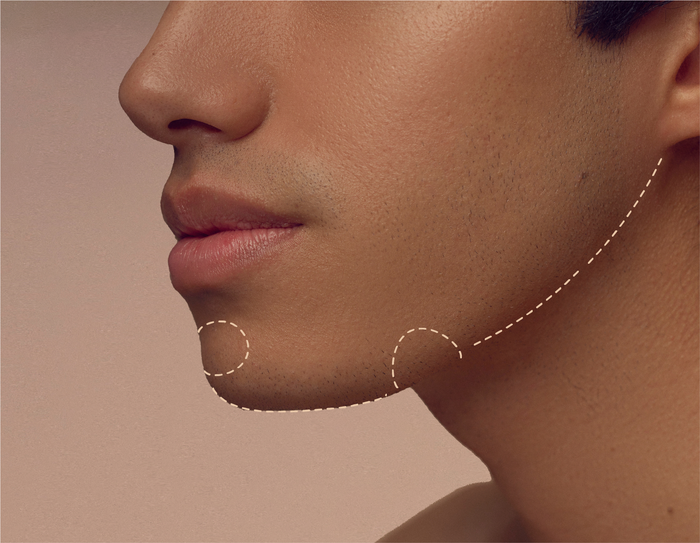 Close-up side view of a persons chin and jawline with two dotted lines on their skin. The background is a soft gradient, and the persons skin tone is even and smooth.