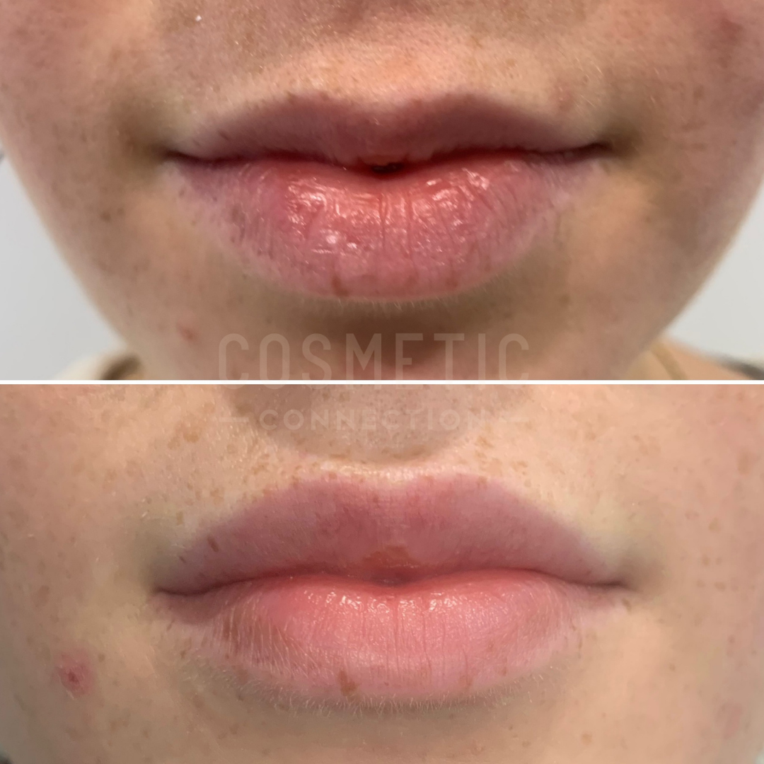 Close-up of lips showing a before-and-after comparison. The top image shows lips with minor cracks and dryness; the bottom image shows smoother, fuller lips with improved texture and hydration, likely after a cosmetic treatment.