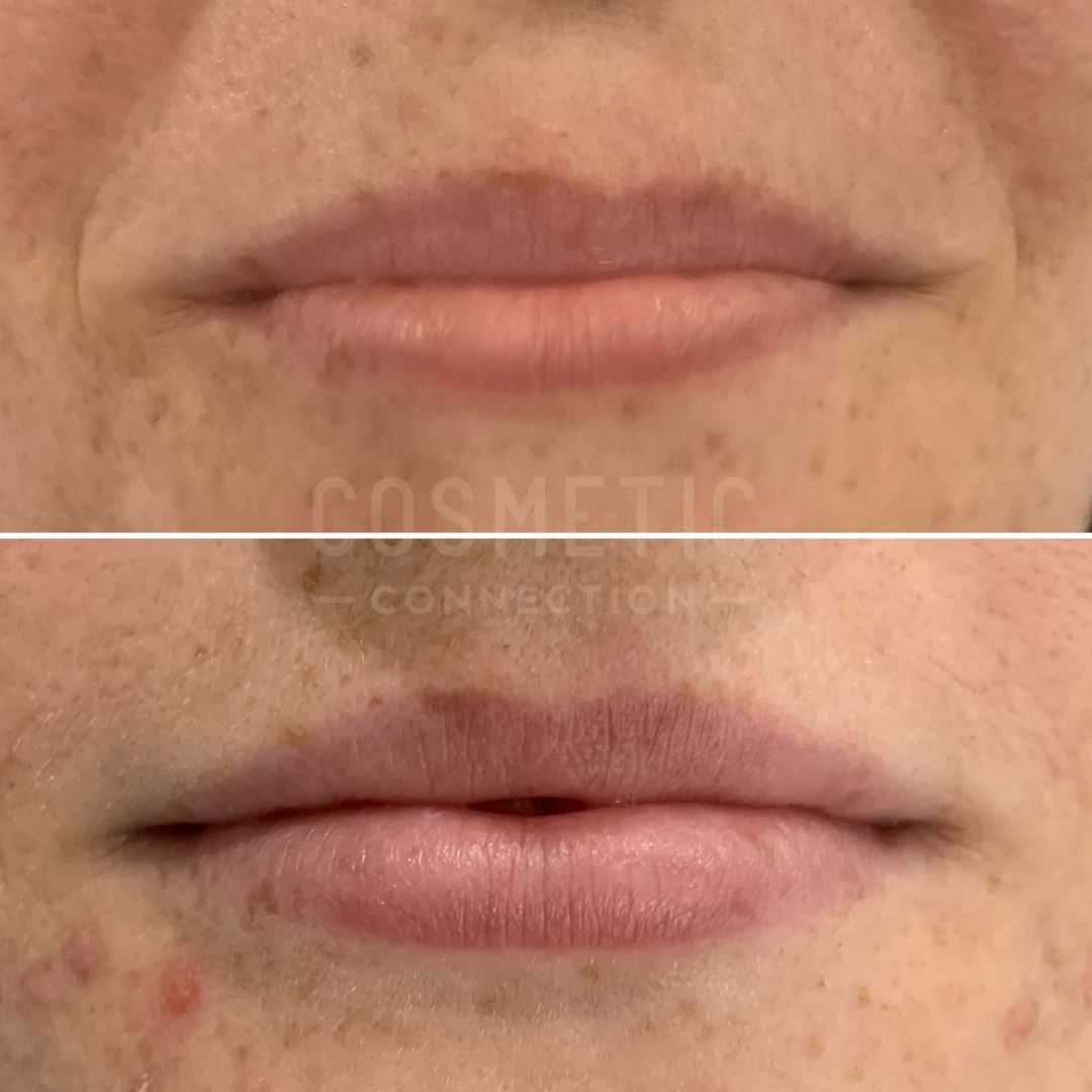 A before-and-after image of lips treated with cosmetic procedures. The top photo shows lips before treatment, and the bottom photo shows fuller, smoother lips after treatment. Subtle improvements in texture and definition are visible.