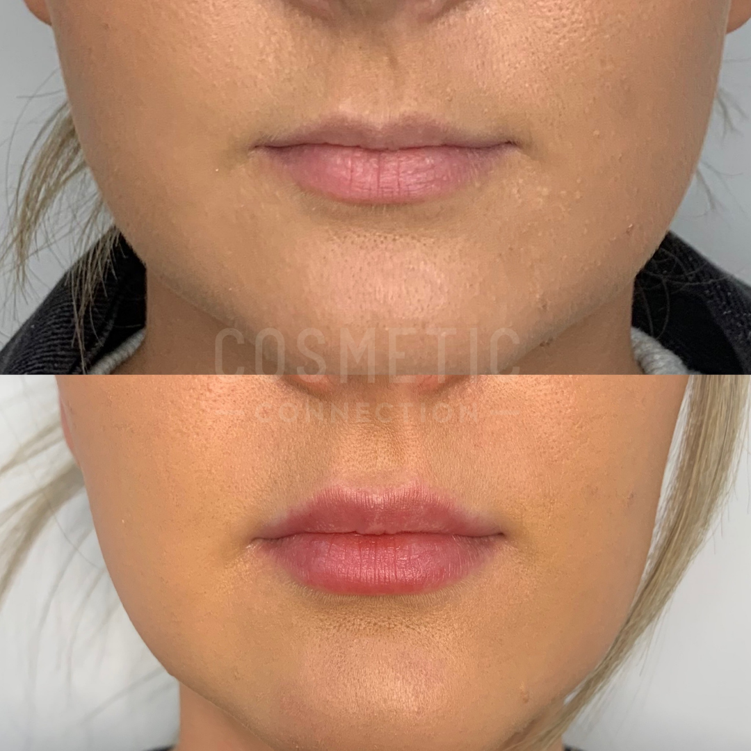 Before and after comparison of a persons lips. The top image shows natural, unenhanced lips, while the bottom image displays fuller, more defined lips, suggesting cosmetic enhancement.
