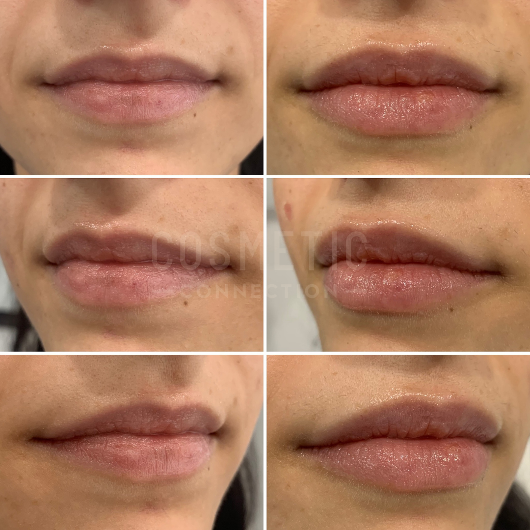 A collage of three before-and-after images showing close-ups of lips undergoing cosmetic enhancement. The top row shows lips before treatment, and the bottom row shows fuller, more defined lips after treatment.