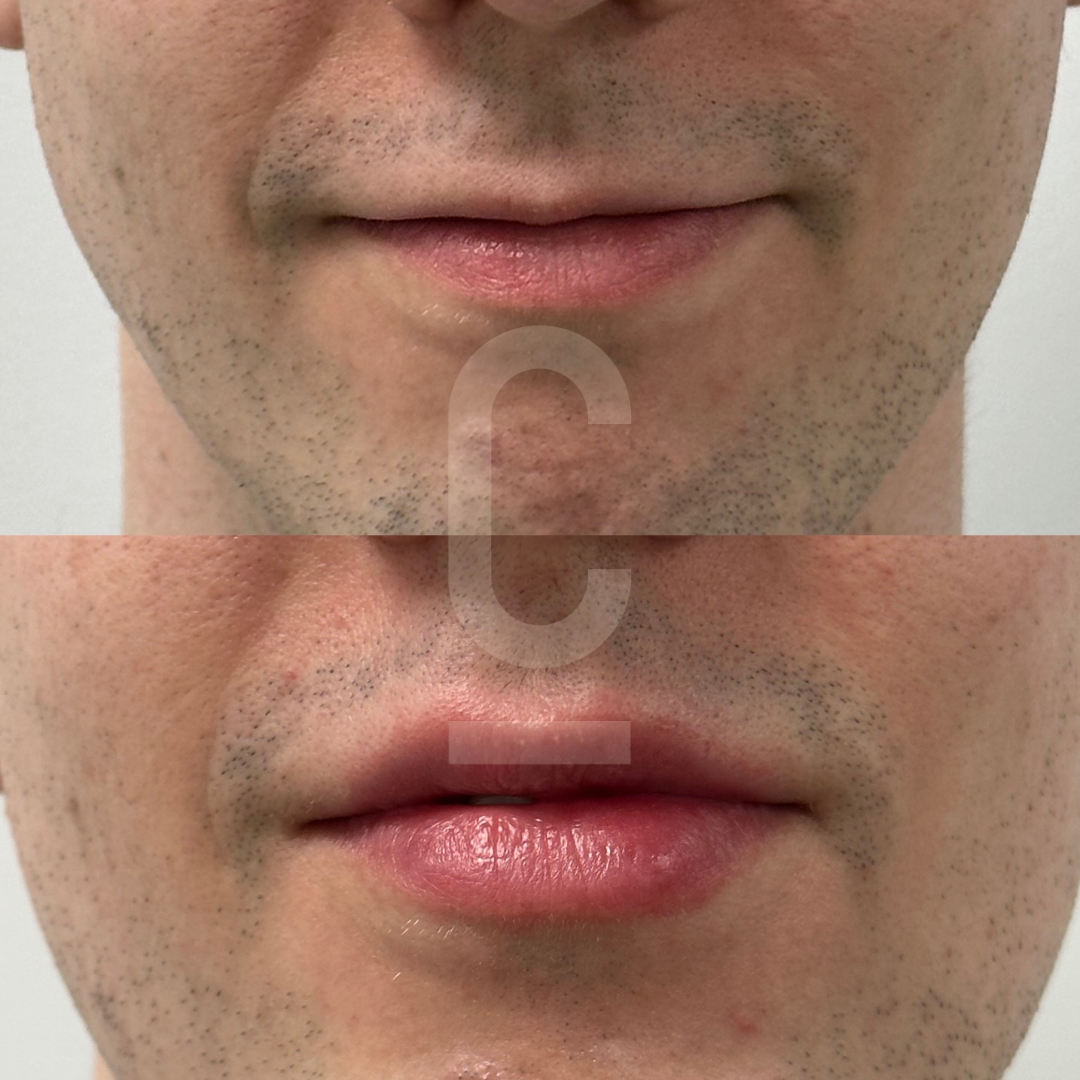 Before and after close-up of a persons lips showing subtle changes. The top image shows a slightly thinner appearance pre-treatment, while the bottom image displays fuller, more defined lips post-treatment.