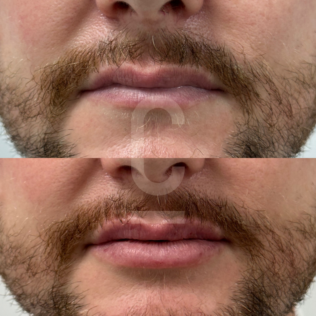 Close-up of a persons lips and chin before and after using a grooming product. The top image shows a slightly dry and less defined lip, while the bottom image displays smoother and more even-toned lips. Both images include a beard.
