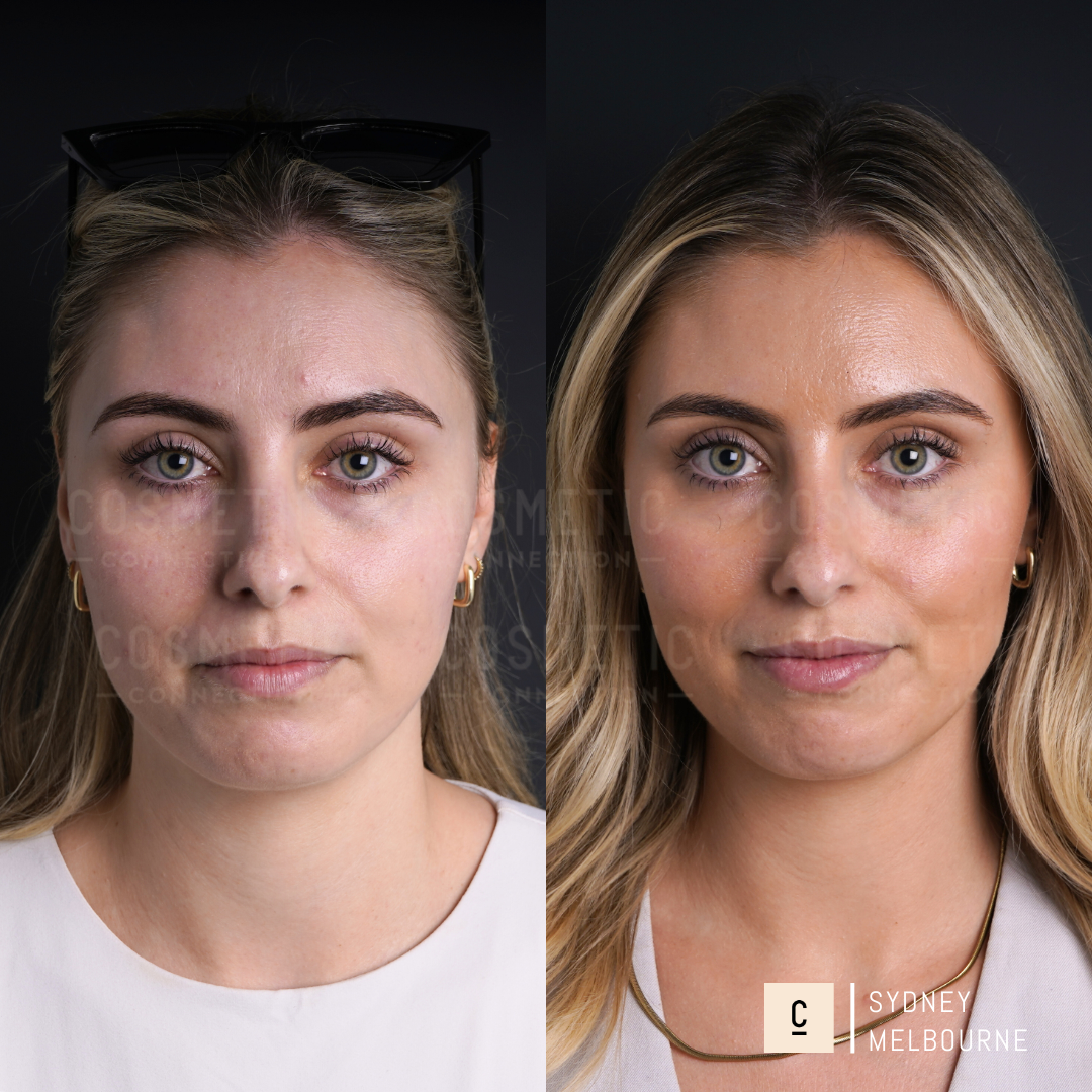 Side-by-side comparison of a woman before and after a cosmetic procedure. Left: the woman with a neutral expression. Right: post-procedure with slight changes in facial features, wearing different makeup and jewelry. Backgrounds are dark.