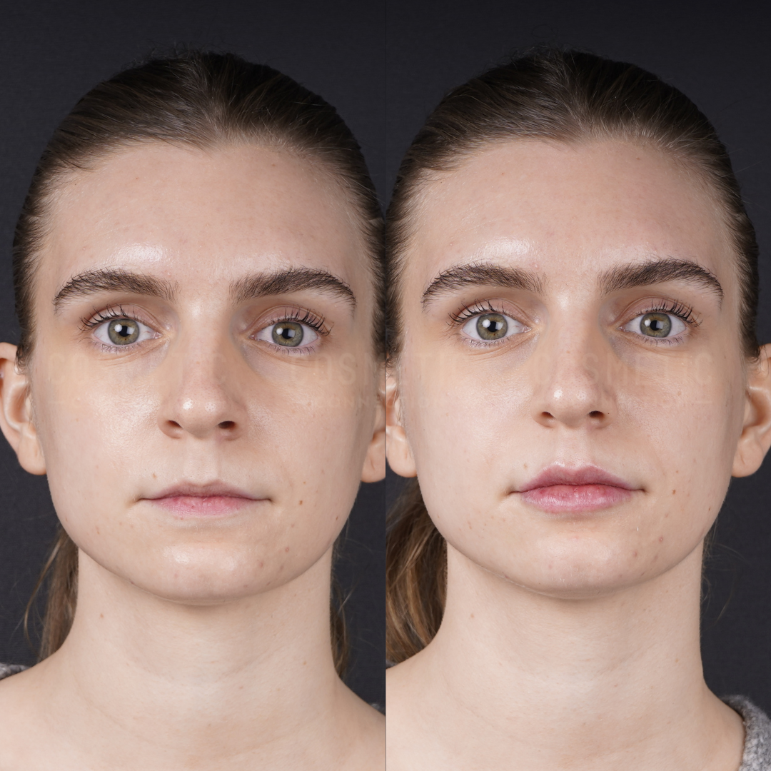 Side-by-side comparison of a woman’s face before (left) and after (right) a treatment, showing subtle changes in skin tone, smoothness, and lip color against a black background.