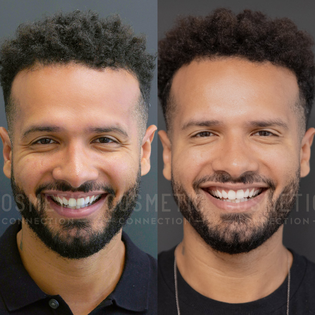 Side-by-side comparison of a man before and after a cosmetic dental procedure. On the left, he wears a black shirt and has a full beard. On the right, his beard is trimmed, and his teeth appear brighter and more aligned. Both images show him smiling.