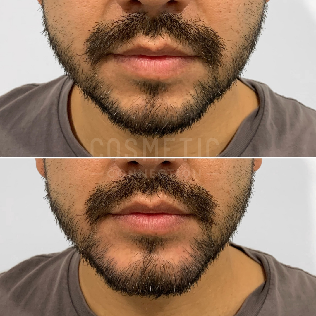 Close-up of a mans face showing a before-and-after comparison of a beard trim. The top image displays a fuller, unkempt beard, while the bottom image shows a neatly trimmed beard. Both images focus on the lower half of the face.