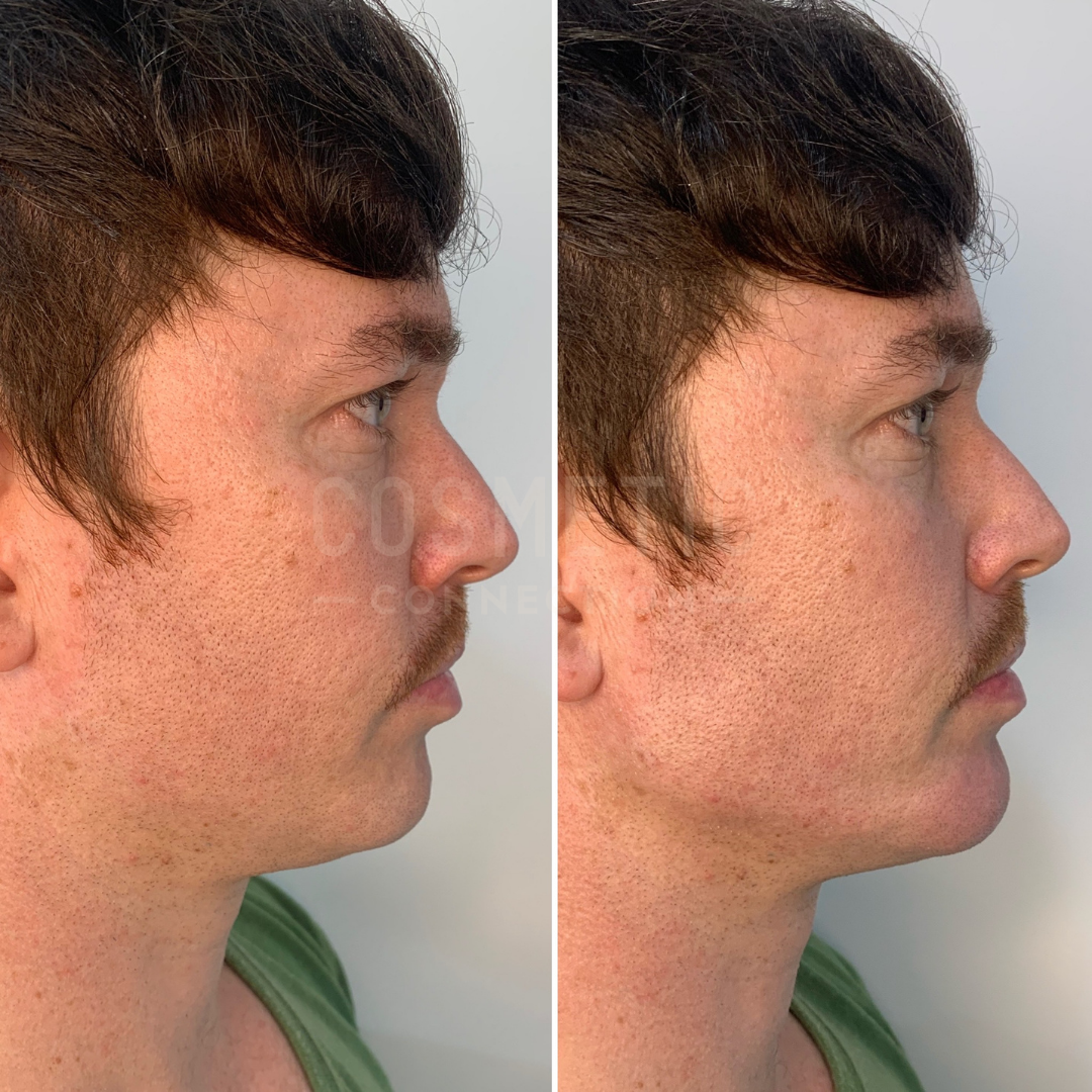 Side-by-side profile images of a person before and after chin augmentation. The left image shows less chin projection, while the right image shows an enhanced chin profile, highlighting the difference pre- and post-procedure.