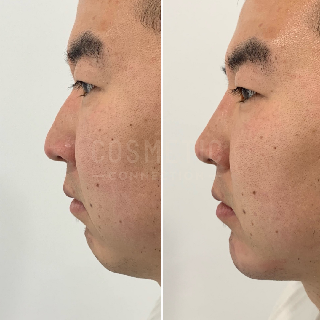 Side-by-side comparison of a mans profile, before and after cosmetic procedure. Left image shows a fuller nose and chin; right image shows a more contoured nose and chin. His expression remains neutral in both images.