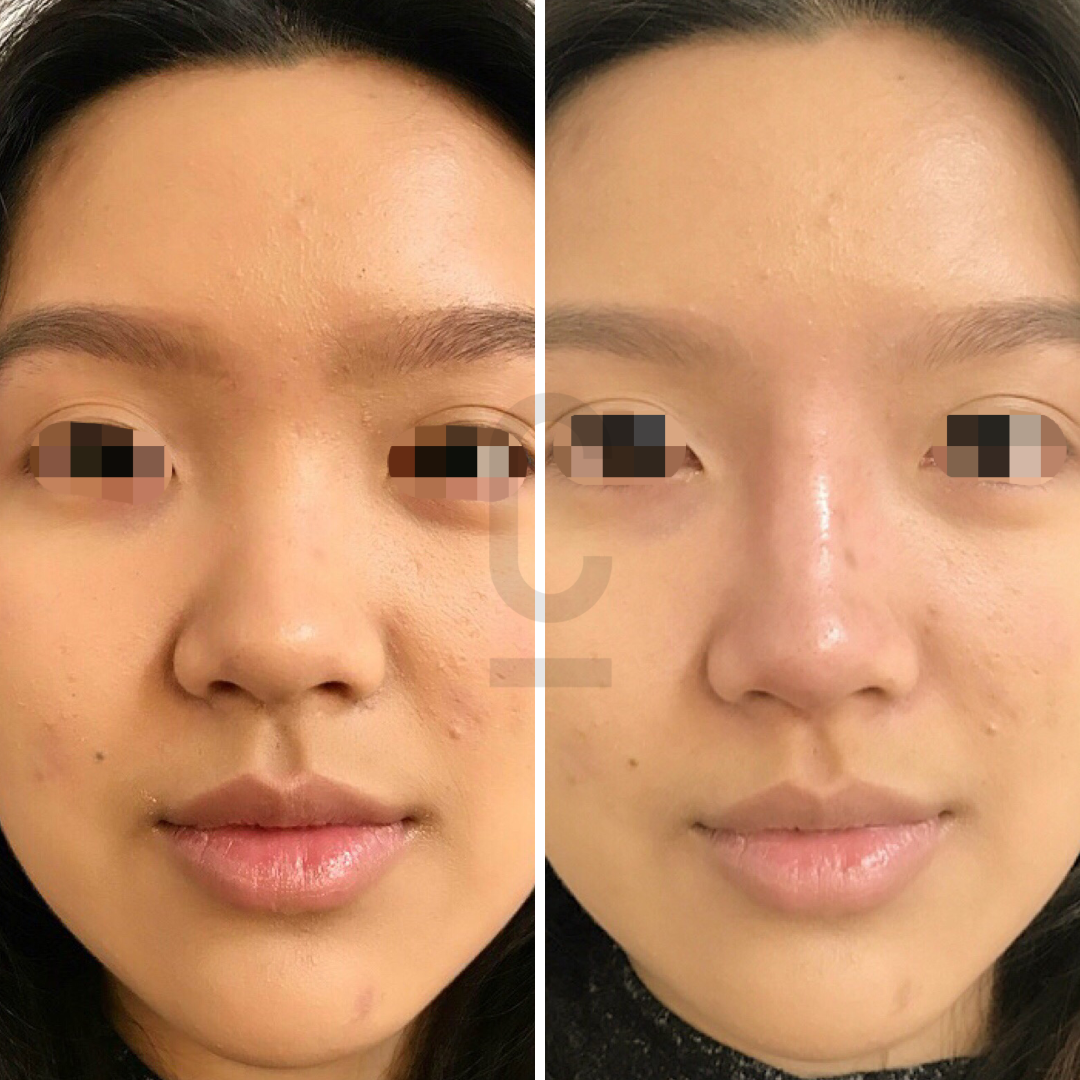 Side-by-side comparison of a womans face before and after skincare treatment. The left image shows slightly more blemishes and uneven skin tone, while the right image exhibits smoother skin with a more even complexion. Eyes are pixelated for privacy.