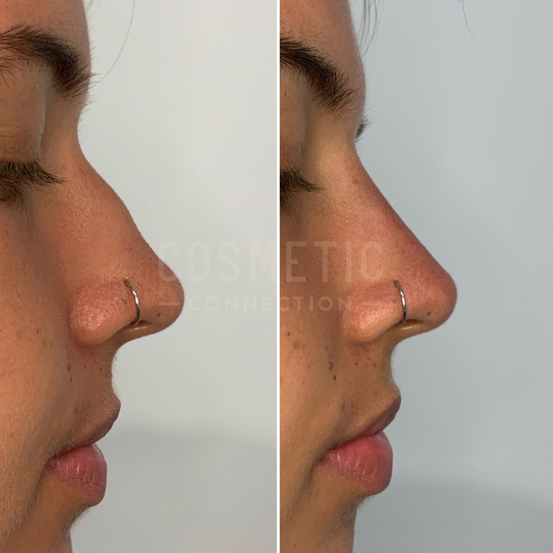 Two side-by-side profile images of a persons face. The left image shows the nose before a cosmetic procedure, and the right image shows the nose after the procedure. Both images feature a small nose ring.