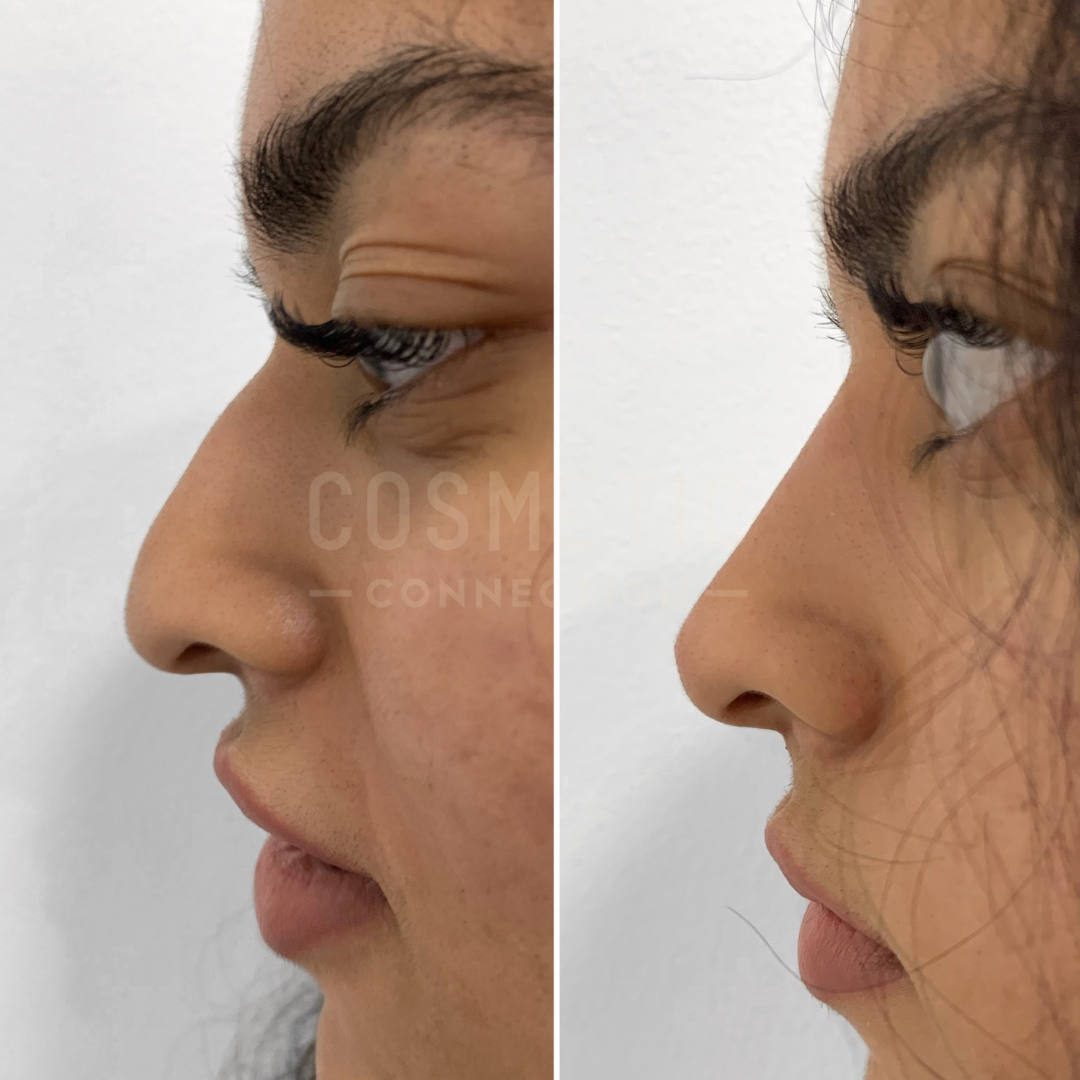 Side-by-side comparison of a persons nose profile before and after cosmetic surgery. The left image shows a more prominent nose and the right image displays a smoother, more refined contour. Both images are from the same angle against a neutral background.