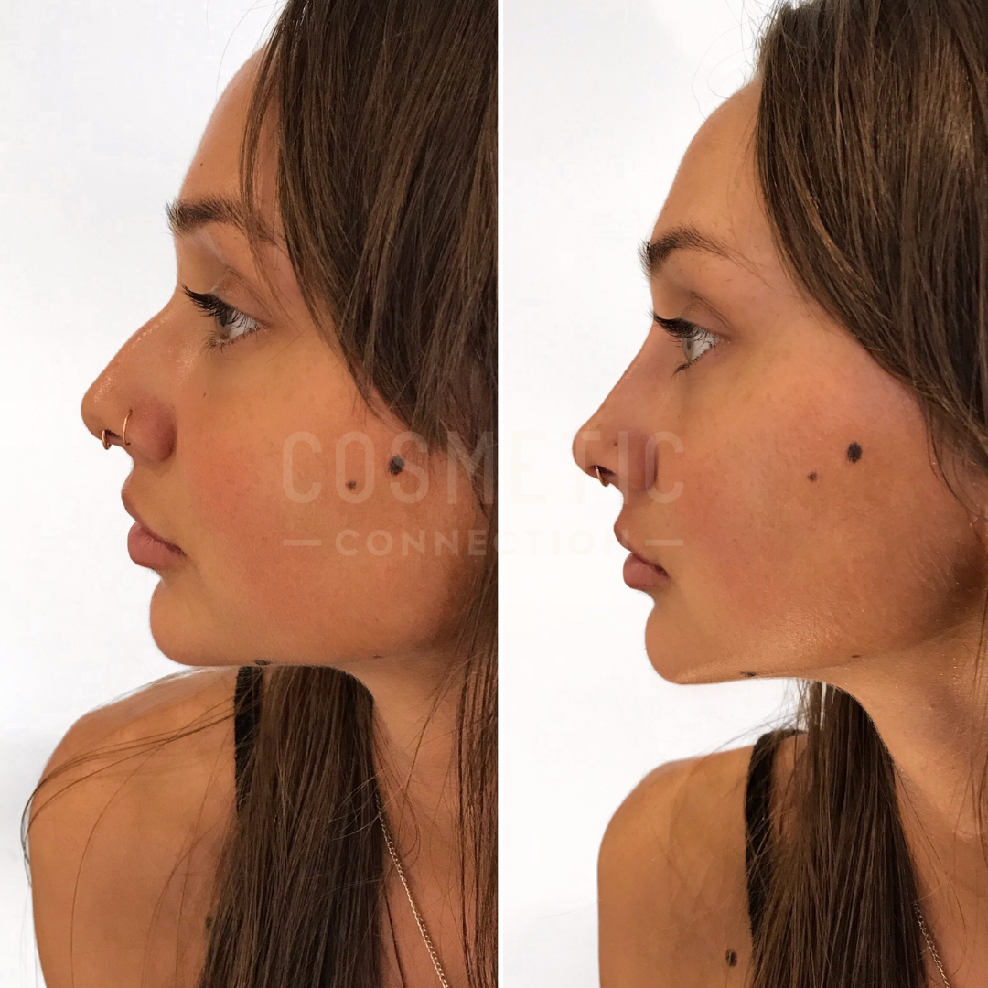 Side-by-side profile images of a woman before and after a cosmetic procedure, highlighting changes to the nose and chin. Both images show her with long hair and a neutral expression, featuring a nose ring and small facial moles.