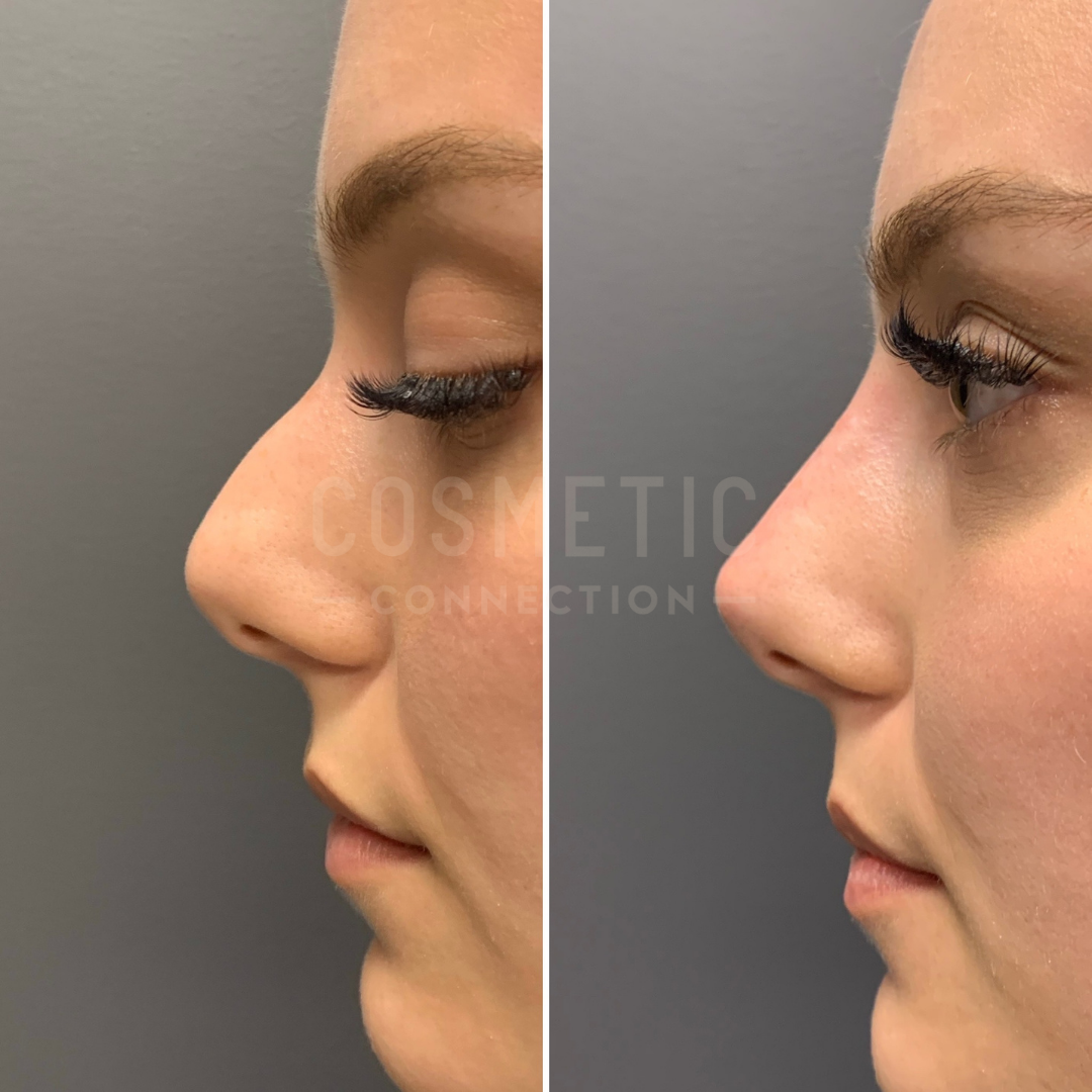 Side-by-side comparison of a persons profile before and after cosmetic surgery. The before image shows a pronounced nose bump, while the after image displays a straighter nose profile.