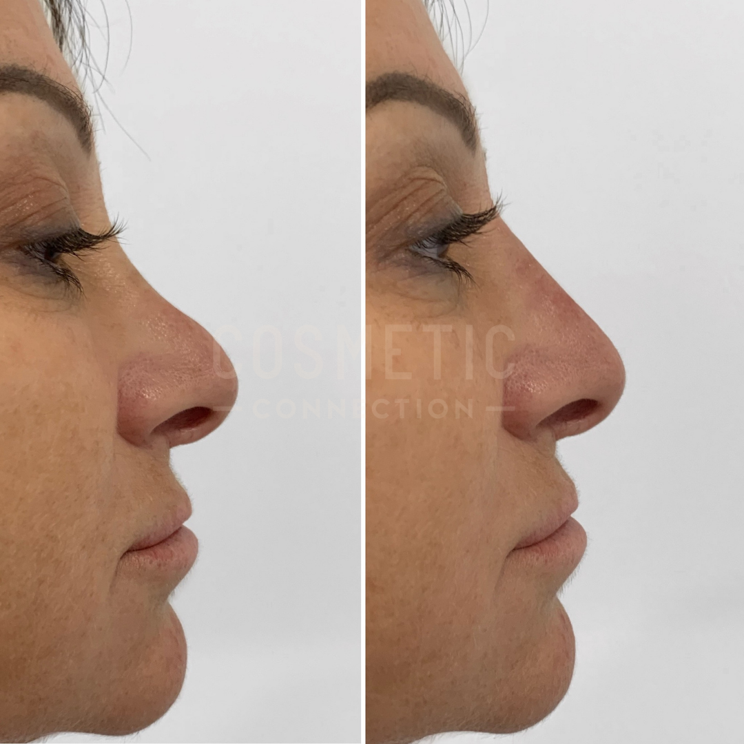 Side-by-side comparison of a womans nose profile before and after a cosmetic procedure. The left image shows the original nose shape, while the right image displays the altered nose with a smoother bridge and more refined tip.