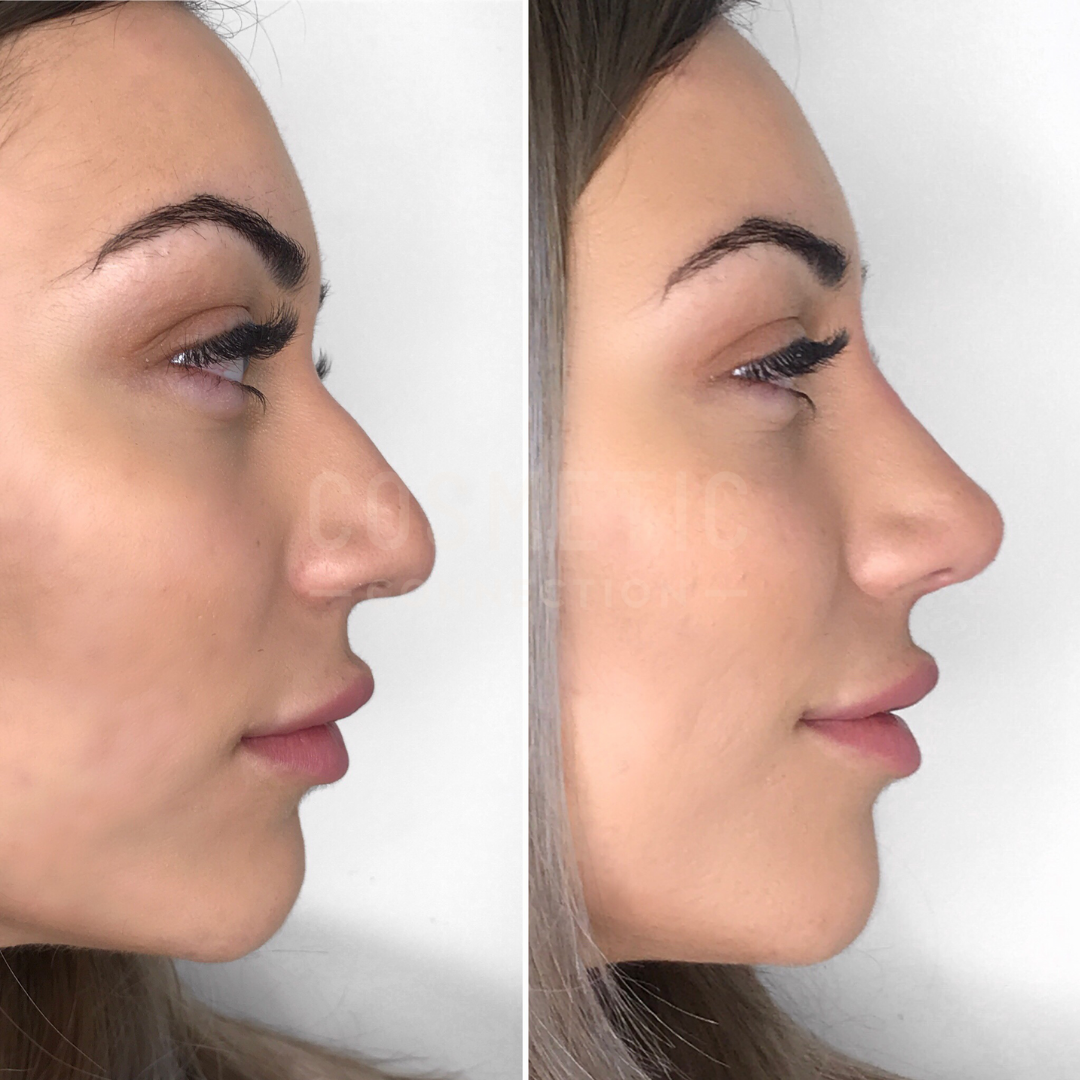 Side-by-side profile photos of the same woman before and after cosmetic surgery. The left image shows a more pronounced nose, and the right image shows a more refined, smaller nose shape. The background is plain white.
