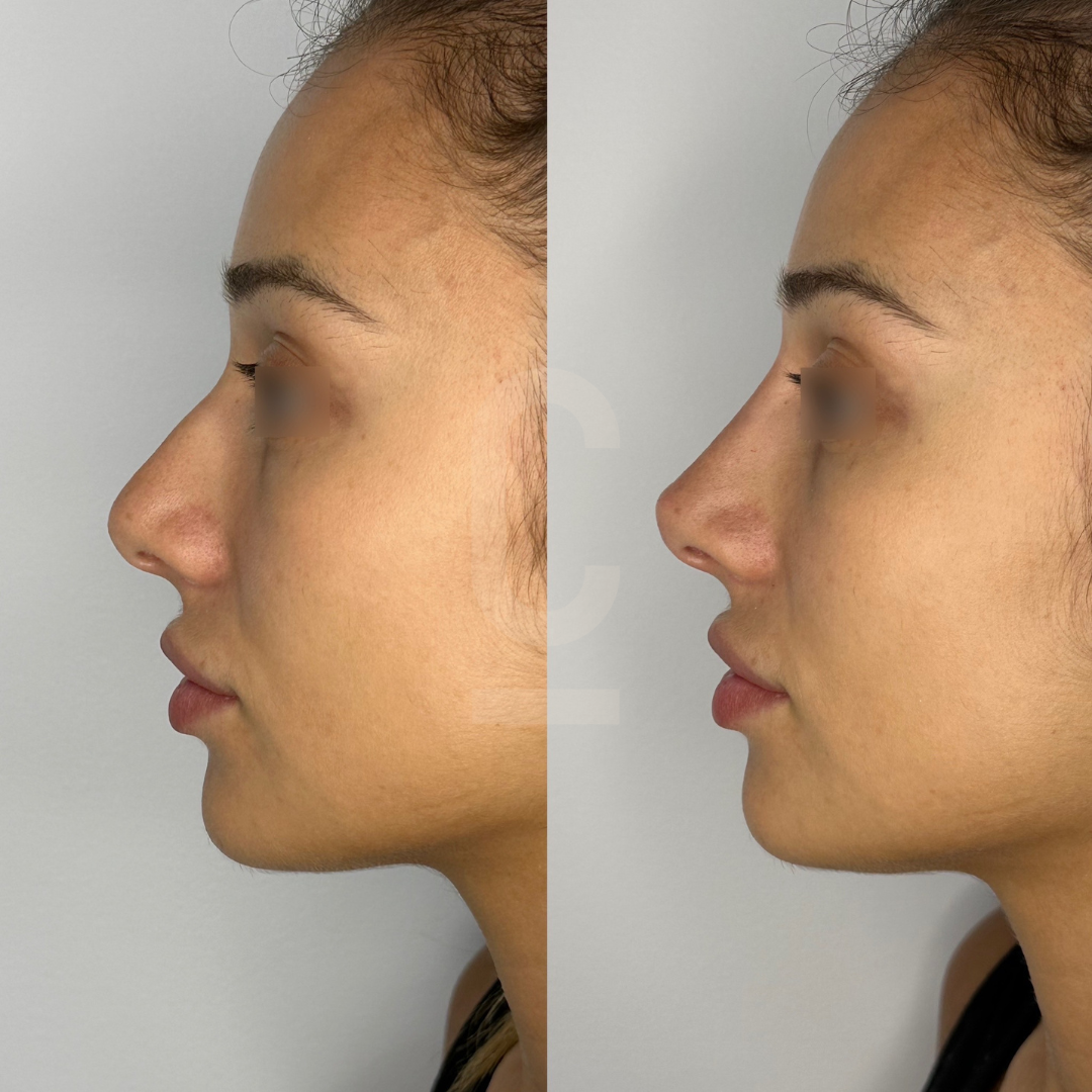 Side-by-side comparison of a womans profile before and after a rhinoplasty. The left image shows a prominent nasal hump, while the right image displays a smoother, more refined nose contour. Both images focus on the face in profile view.