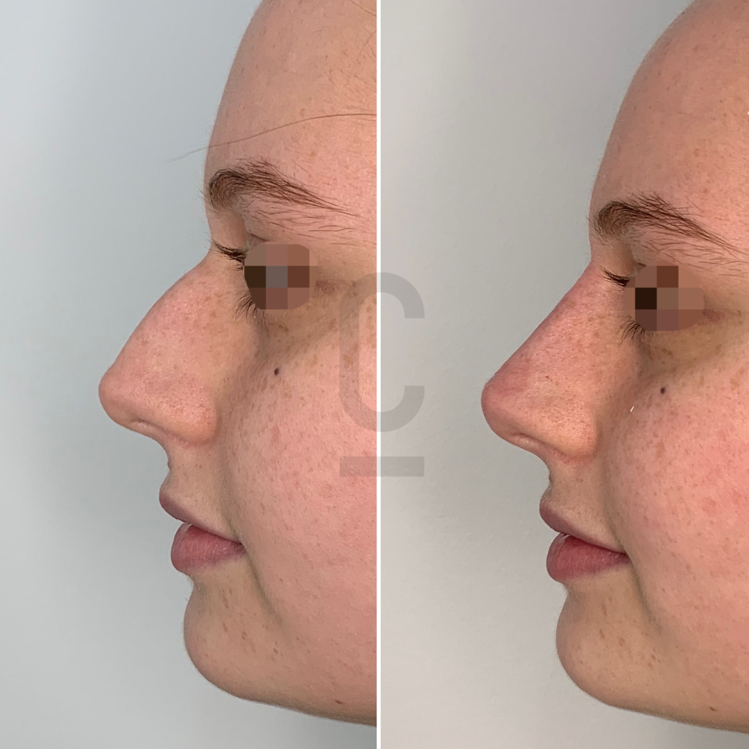 Side-by-side profile images of a persons face, showing a before and after comparison. The left image shows the nose with a noticeable bump, while the right image shows a smoother nose profile. Eyes are pixelated for privacy.