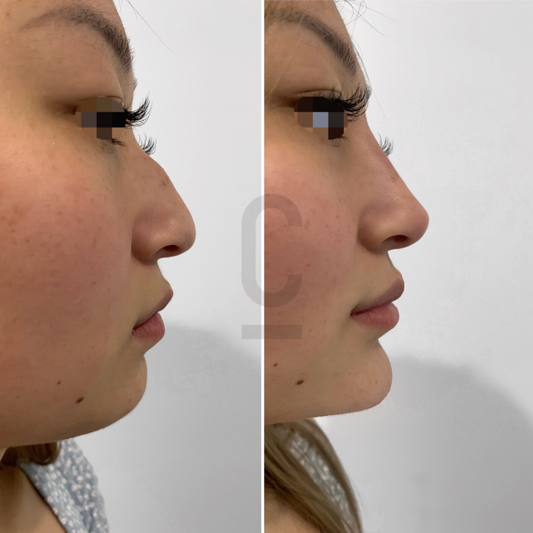 Side-by-side profile images of a womans face before and after a cosmetic procedure. The left image shows a natural nose, while the right image displays a more refined nose shape. The background is plain white.