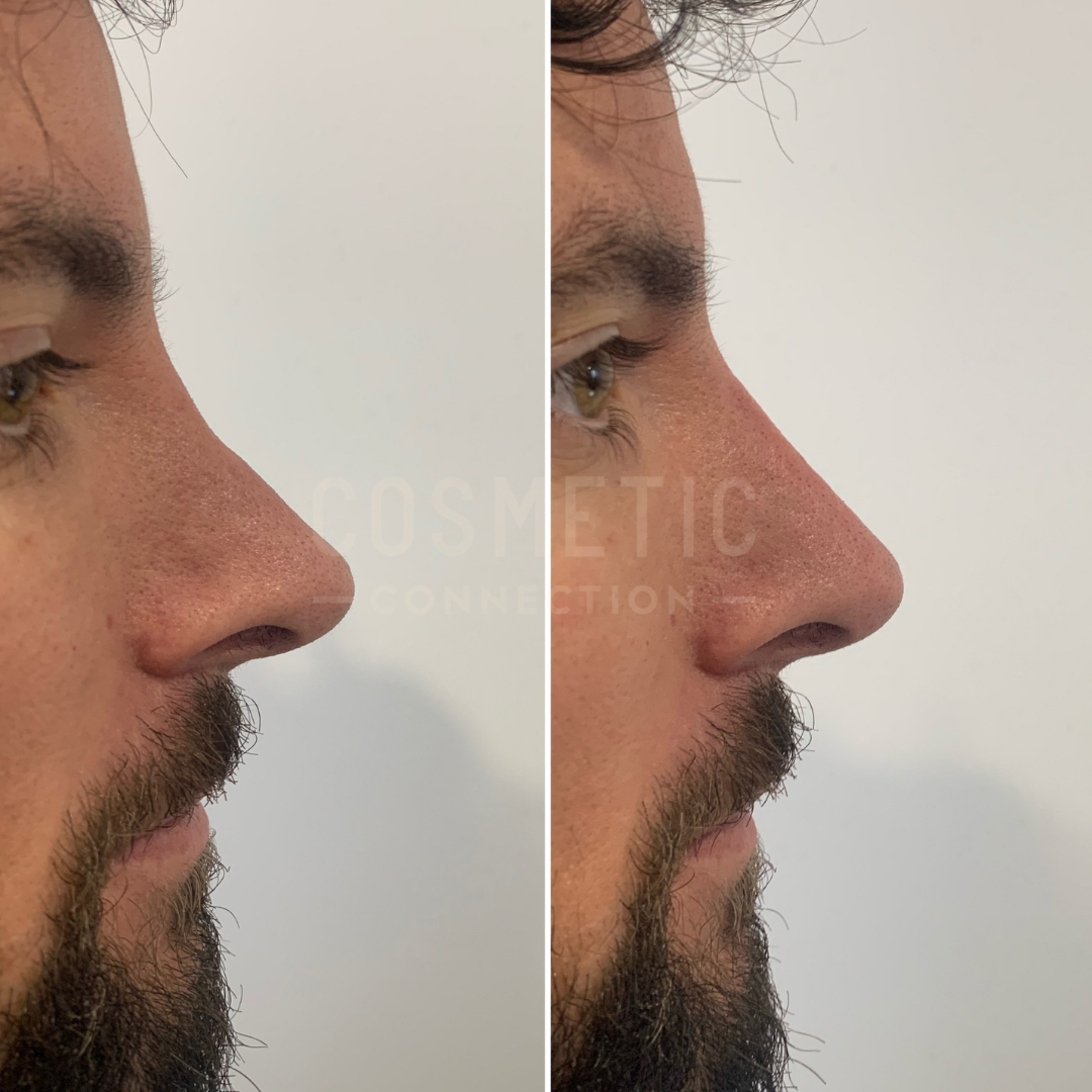 Side-by-side images of a persons face in profile, before and after a rhinoplasty procedure. The left image shows a natural nose, and the right image shows a smoother, more refined nasal profile.