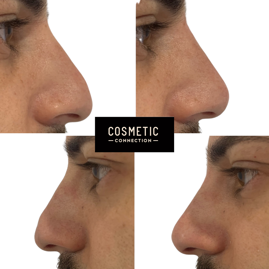 A collage of four profile views of a persons nose, showcasing two images on the left and two on the right. The center has a logo that reads Cosmetic Connection.