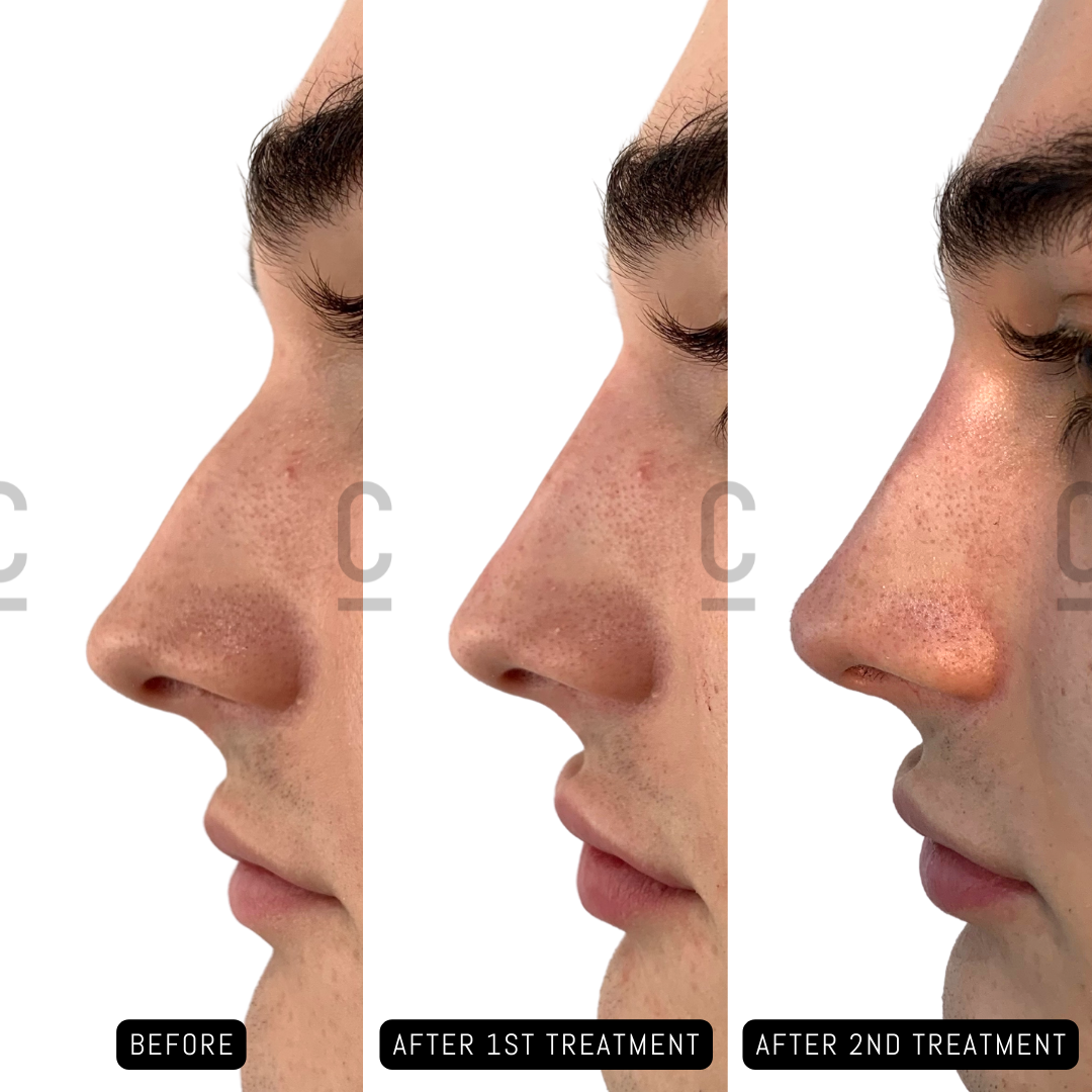 Side profile view of a persons nose shown in three stages: before treatment, after the first treatment, and after the second treatment. Subtle changes in nose shape are visible across the images.