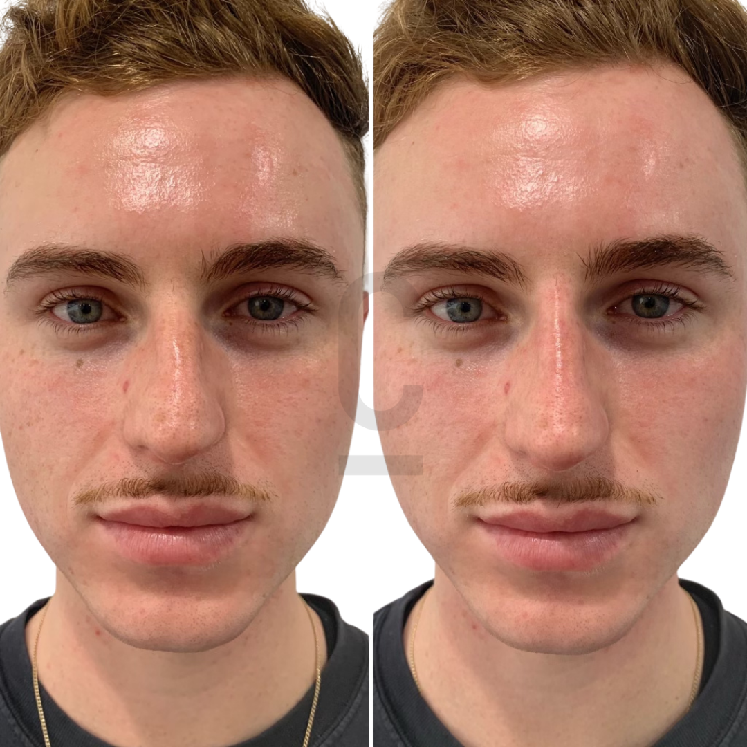 Side-by-side close-up photos of a mans face with subtle differences in lighting and facial expression. He has short light brown hair, a small mustache, and is wearing a dark shirt. The background is plain white.