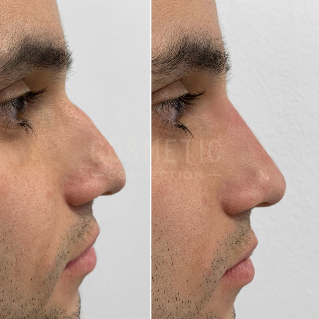 Side-by-side profile images showing a persons nose before and after rhinoplasty. The left image displays a slightly curved nose, while the right image shows a straighter nose with a more refined shape.