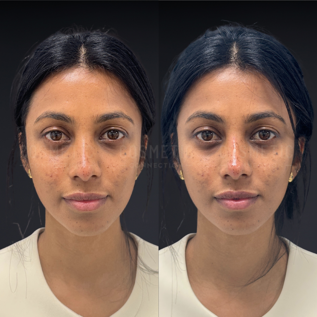 Side-by-side comparison of a woman’s face before (left) and after (right) a treatment; differences include a smoother complexion, reduced under-eye circles, and more even skin tone in the after image.
