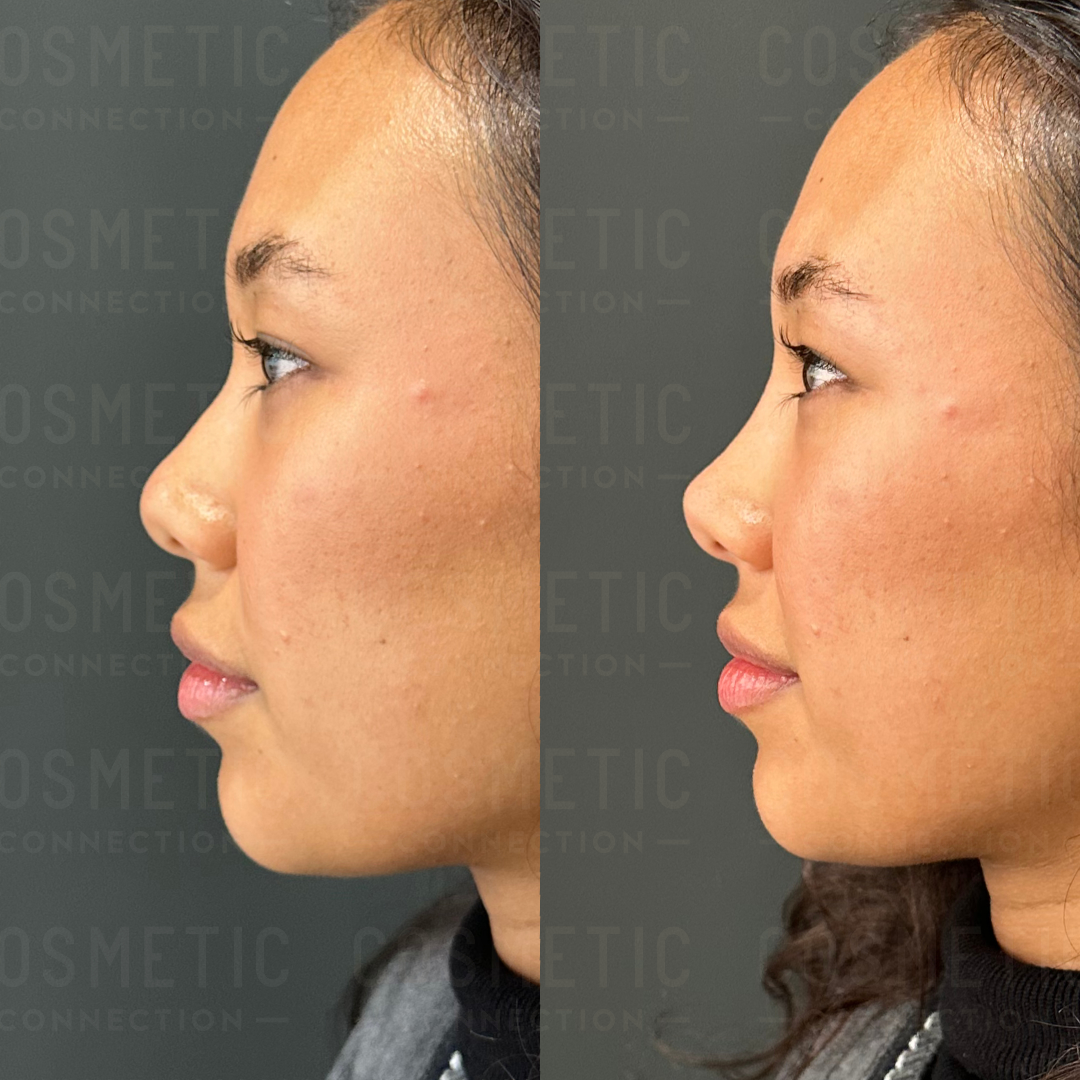 Side-by-side profile images of a person before and after a nose and chin procedure. The left image shows the original profile, while the right image shows a more defined nose bridge and chin. The background is a gray wall with faint text.