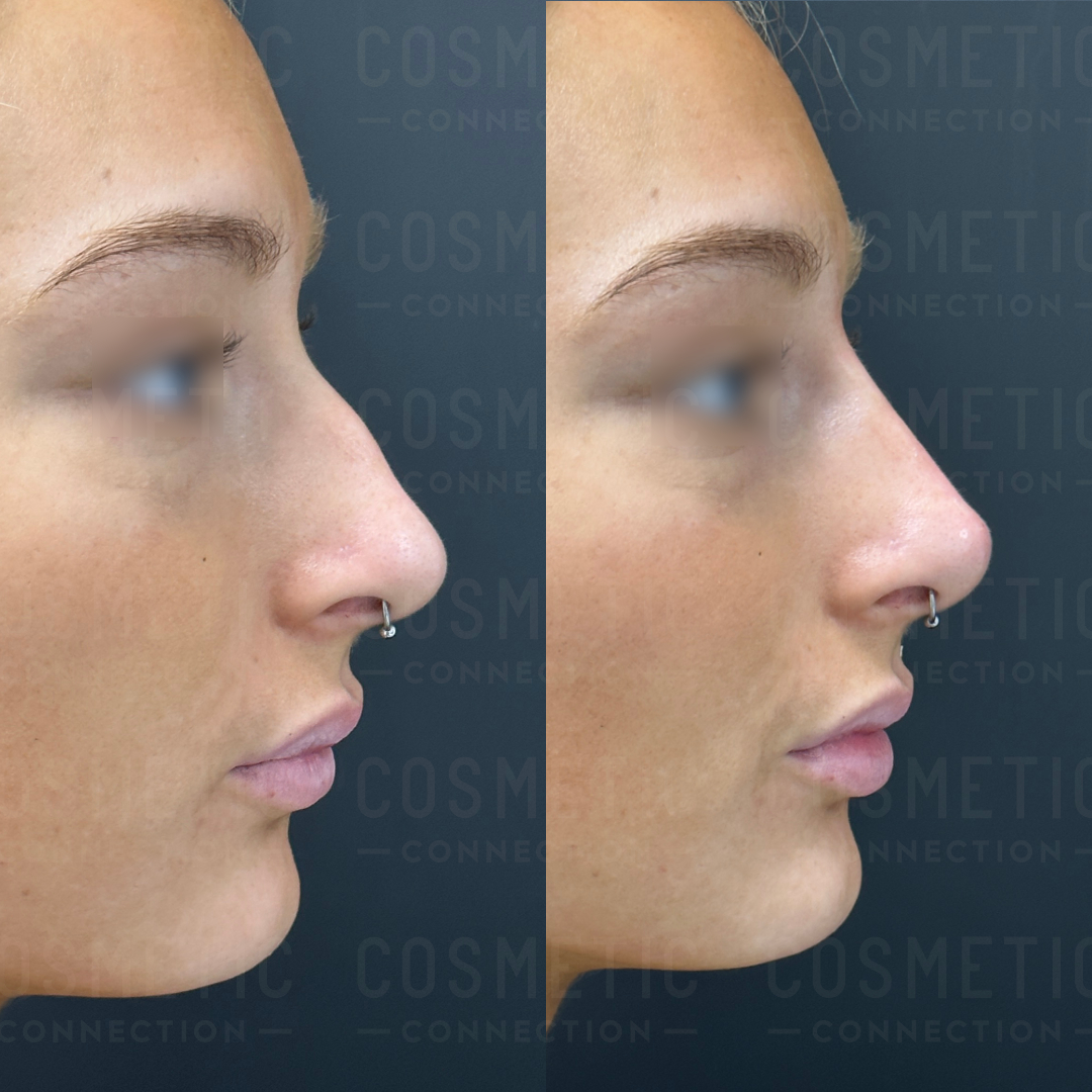 Side-by-side profile views of a person with a nose piercing, before and after a cosmetic nose procedure. The image shows a noticeable change in the shape of the nose.