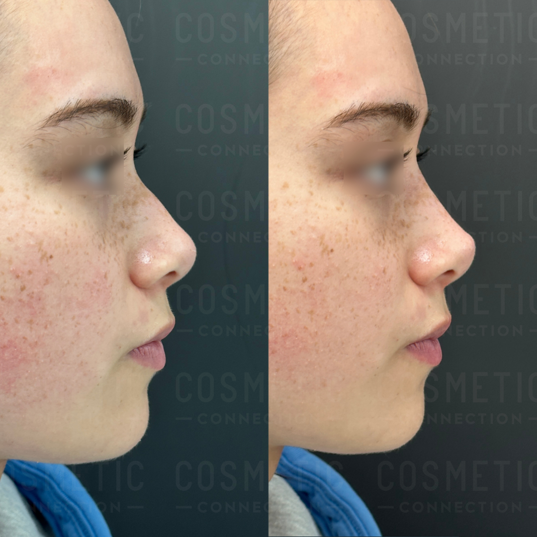 Side-by-side comparison of a persons facial profile before and after a cosmetic procedure. The images show adjustments to the nose and chin. The background is dark and features faint text saying COSMETIC CONNECTION.