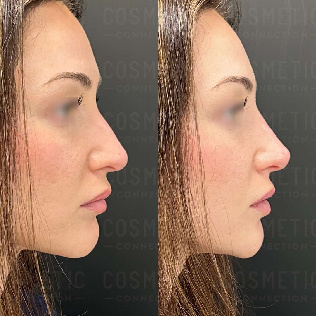 Side-by-side profile photos of a womans face before and after cosmetic treatment. The left image shows a natural profile, while the right image shows alterations, such as a more defined jawline and smoother skin texture.