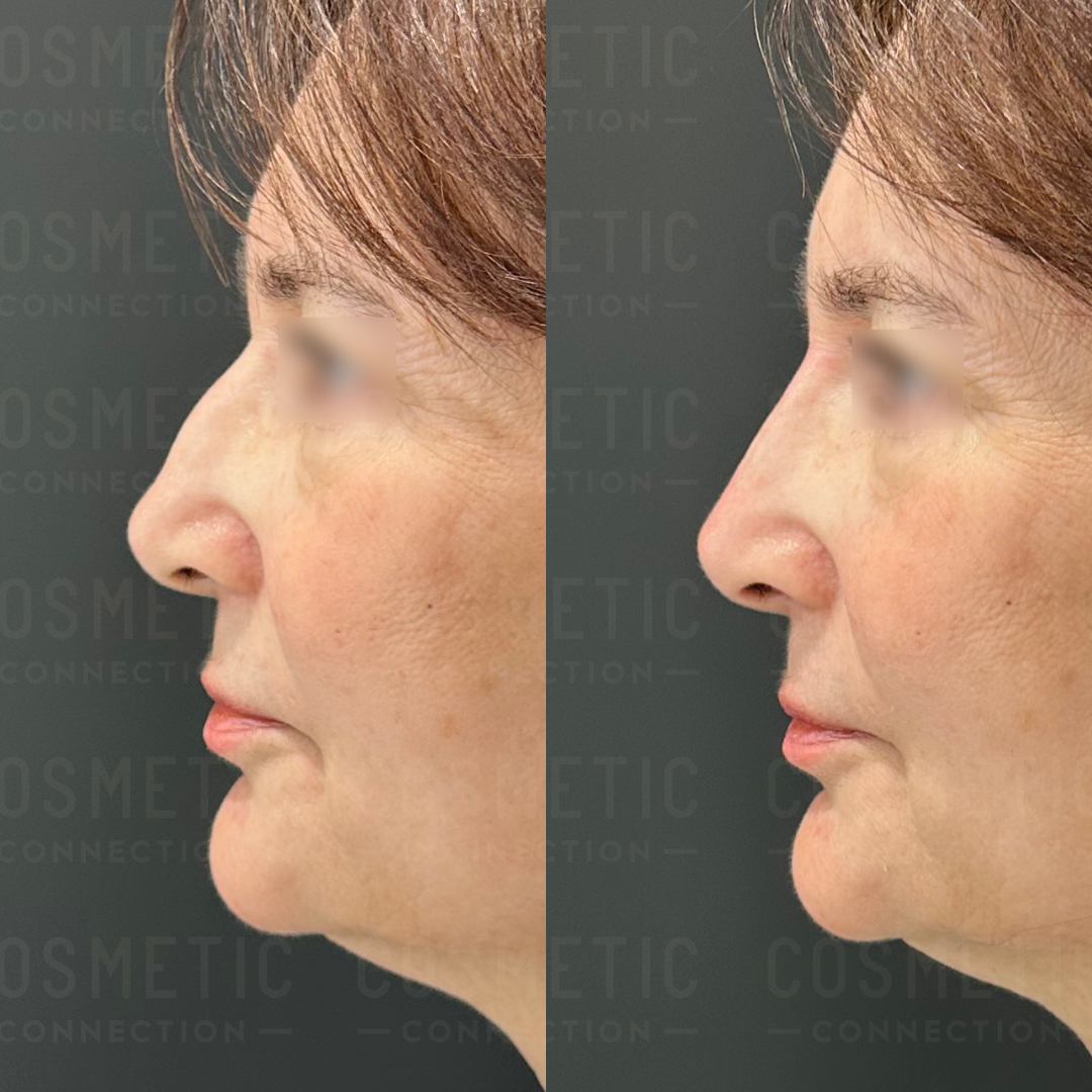 Side-by-side comparison of a womans profile before and after cosmetic treatment. The first image shows a slightly drooping nose and fuller chin, while the second image shows a more lifted nose and refined chin contour.