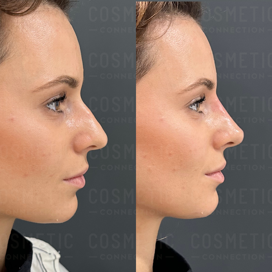 Side-by-side comparison of a persons profile showing a natural-looking nose transformation. The left image displays the nose before treatment, while the right image shows a more refined nose shape after the procedure.