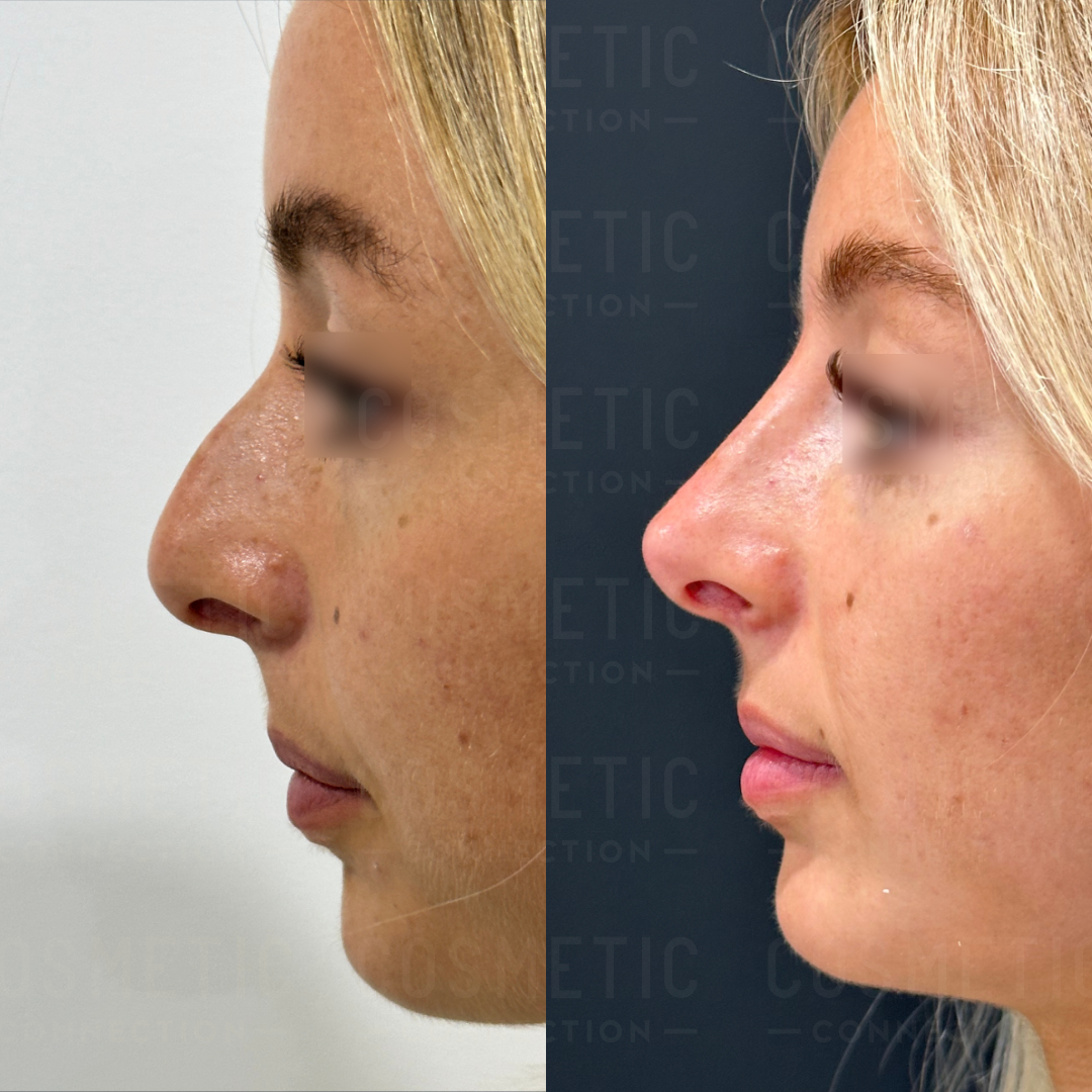 Side-by-side comparison of a persons profile before and after rhinoplasty. The left image shows a nose with a prominent bridge, and the right image shows a smoother, refined nose contour post-surgery.